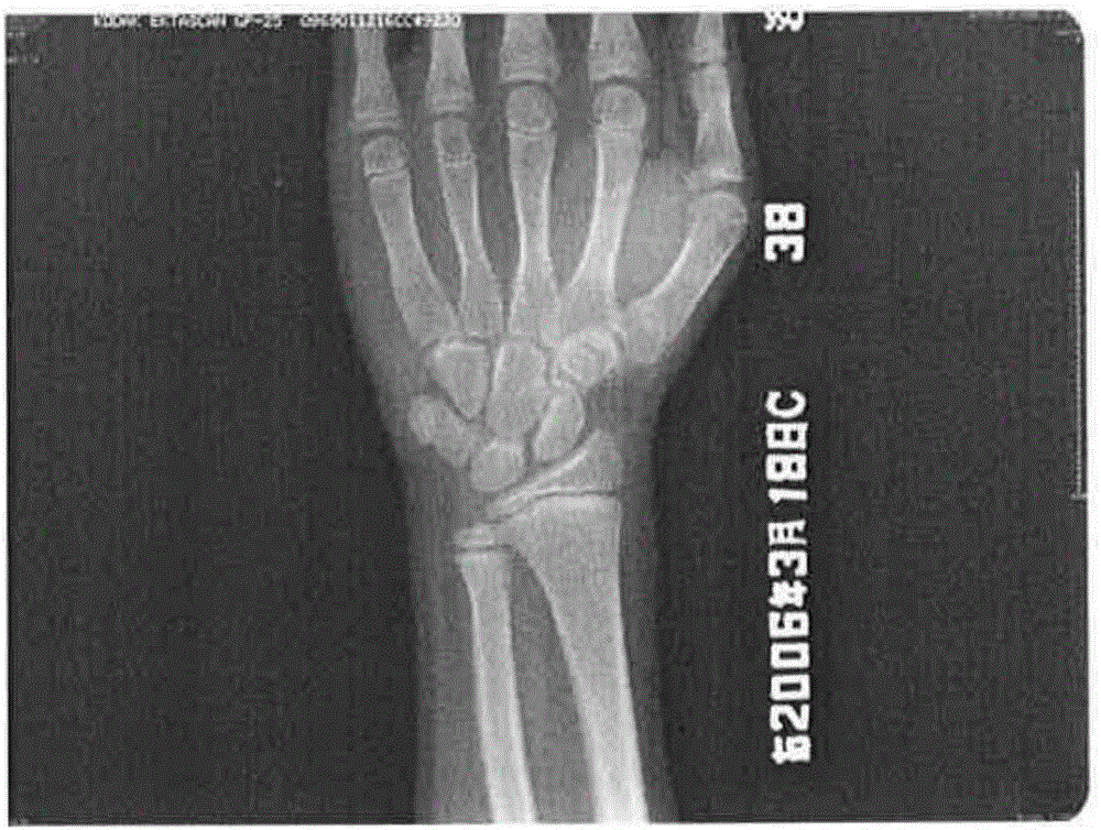 Bone age assessment method