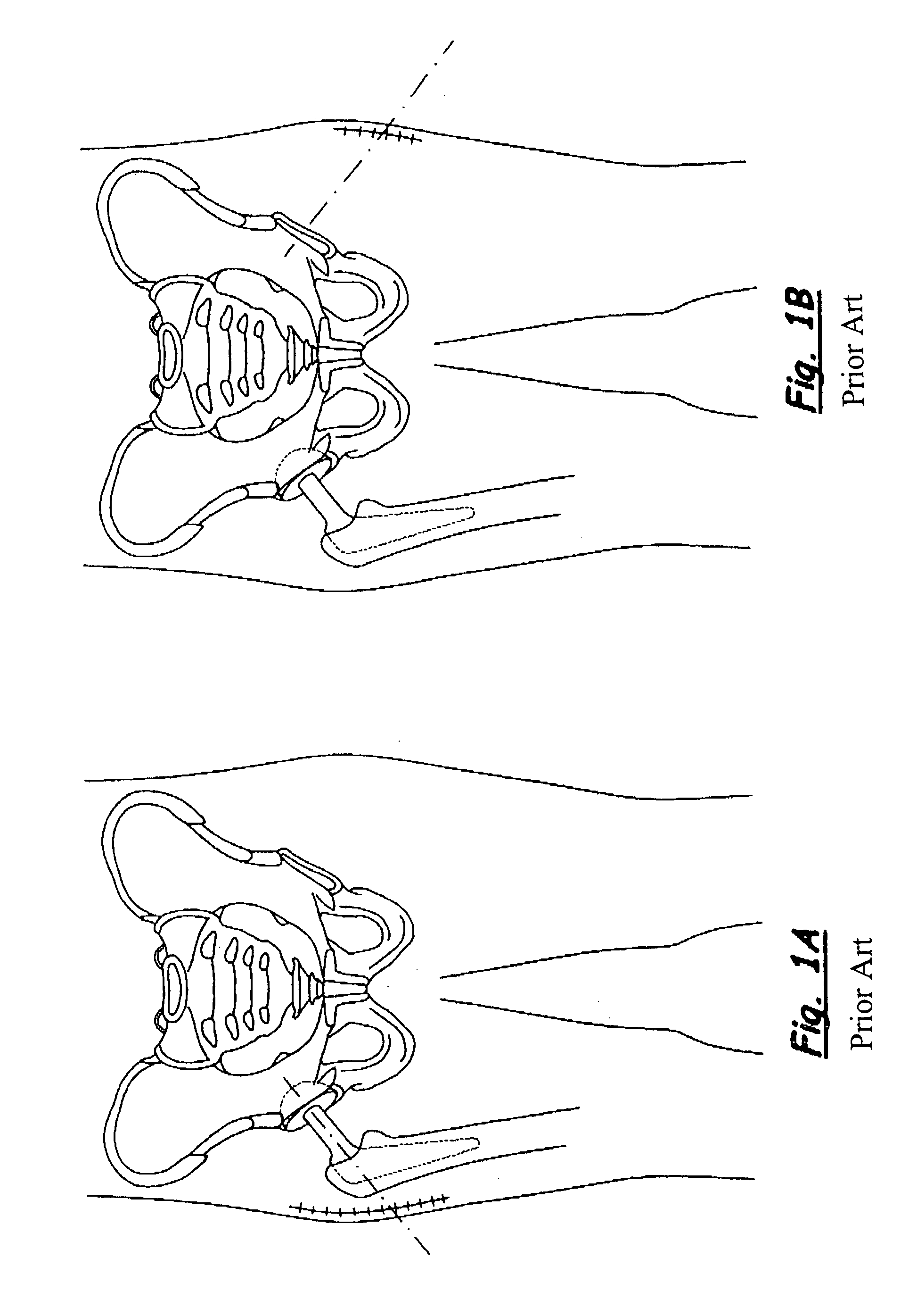 Expandable surgical reaming tool