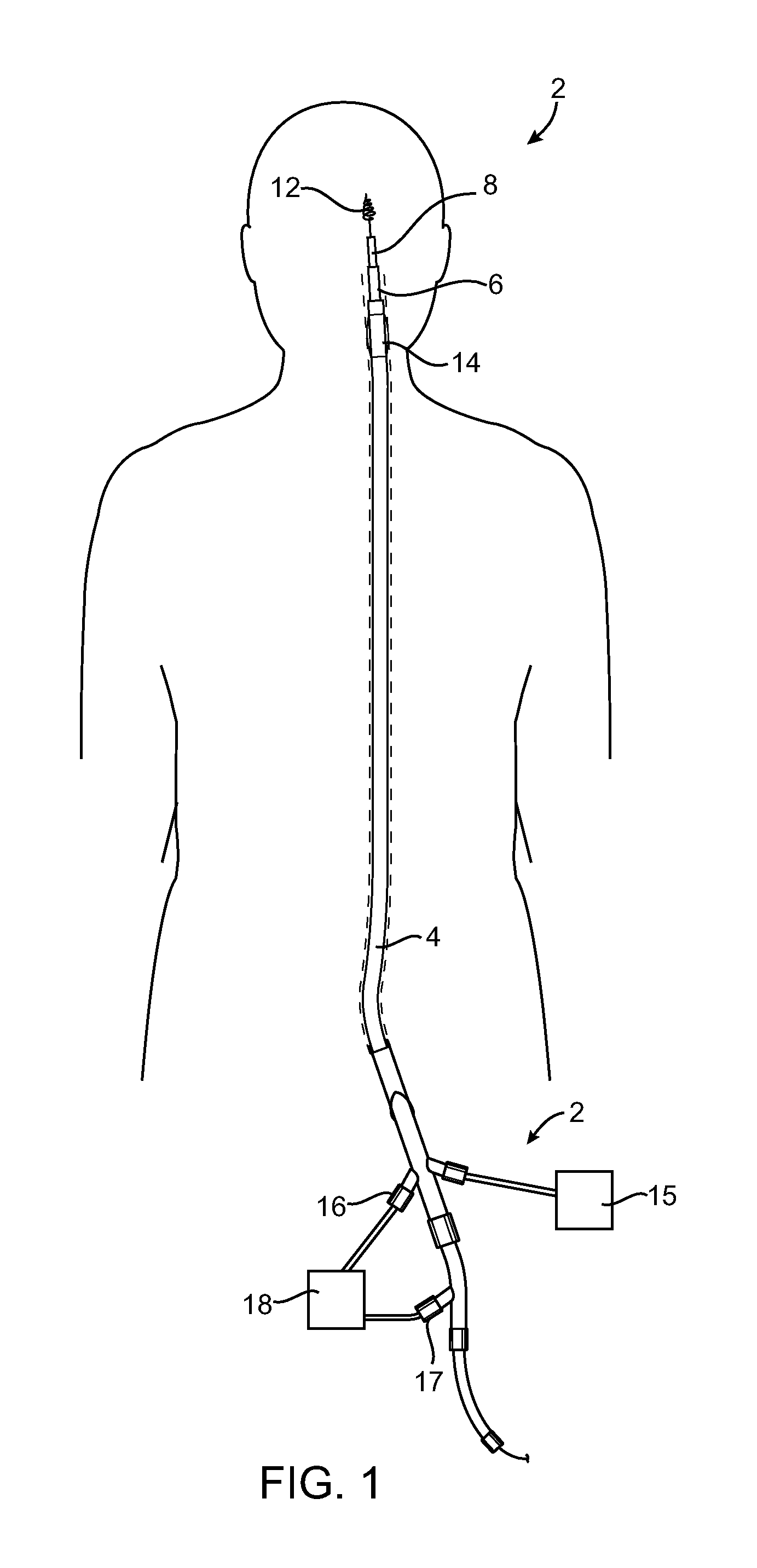 Devices and methods for accessing a cerebral vessel