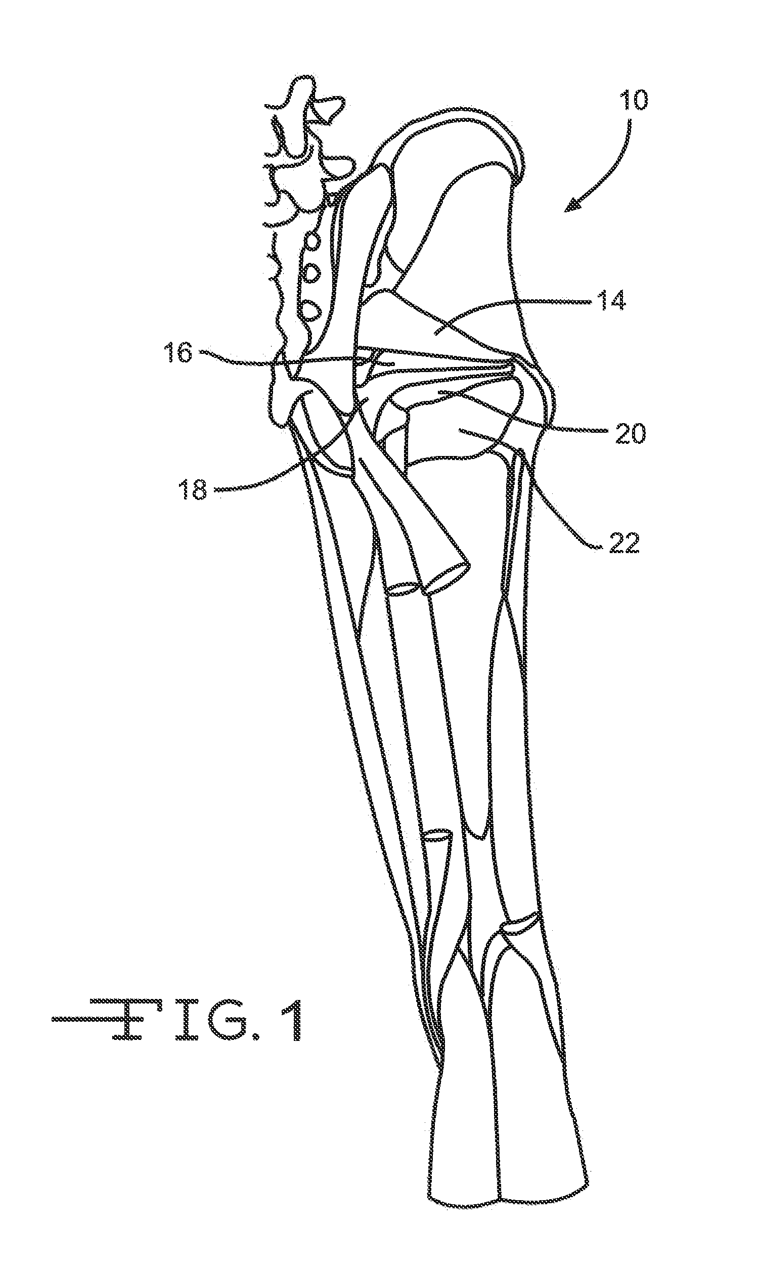 Retractor tools for minimally invasive hip surgery