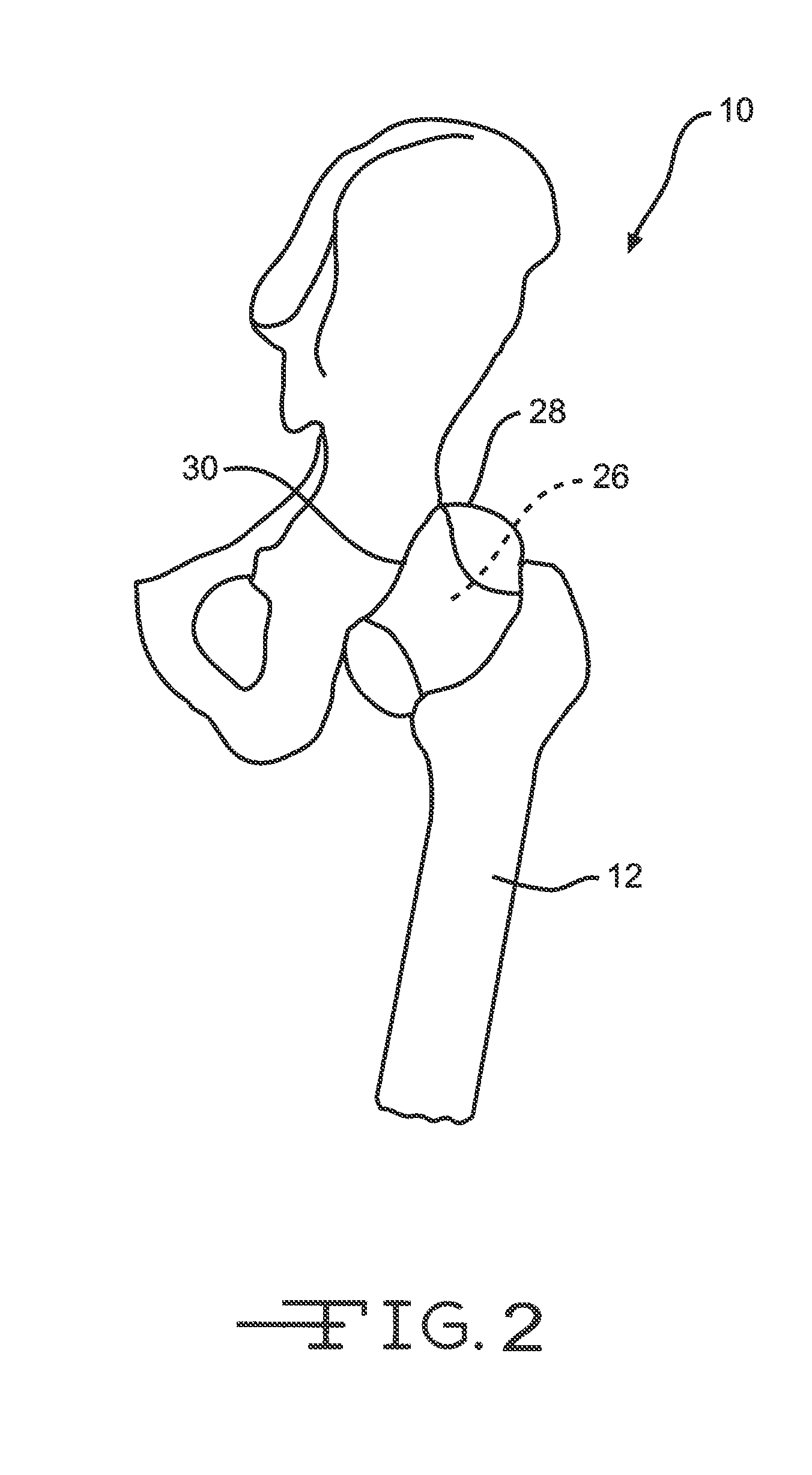 Retractor tools for minimally invasive hip surgery