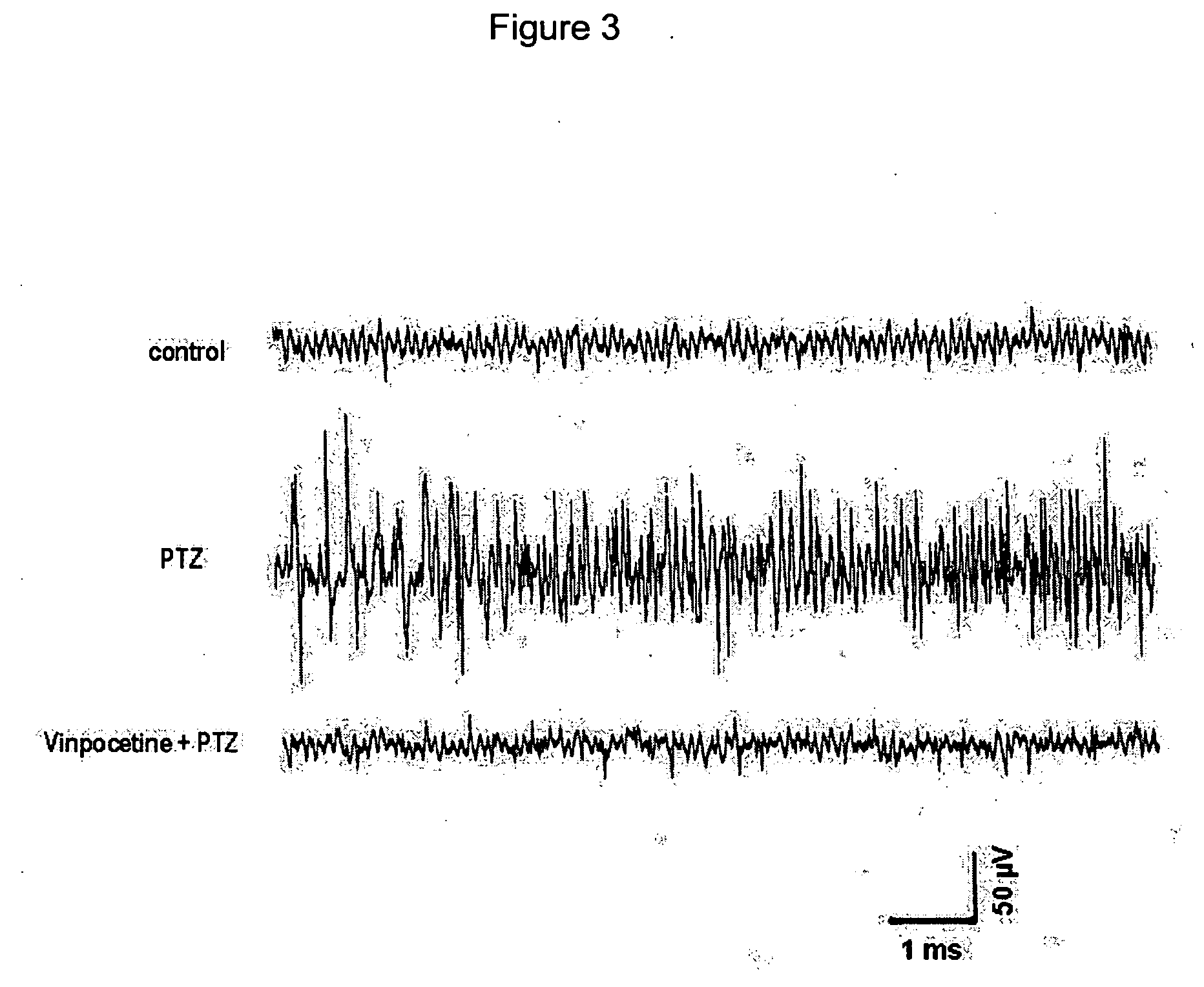 Utilization of vinpocetine to avoid complications in particular those associated to hearing which occur with epilepsy, and treatment thereof