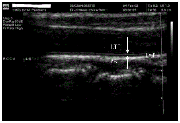 Ultrasonic carotid artery intima media thickness measurement device and method based on deep learning