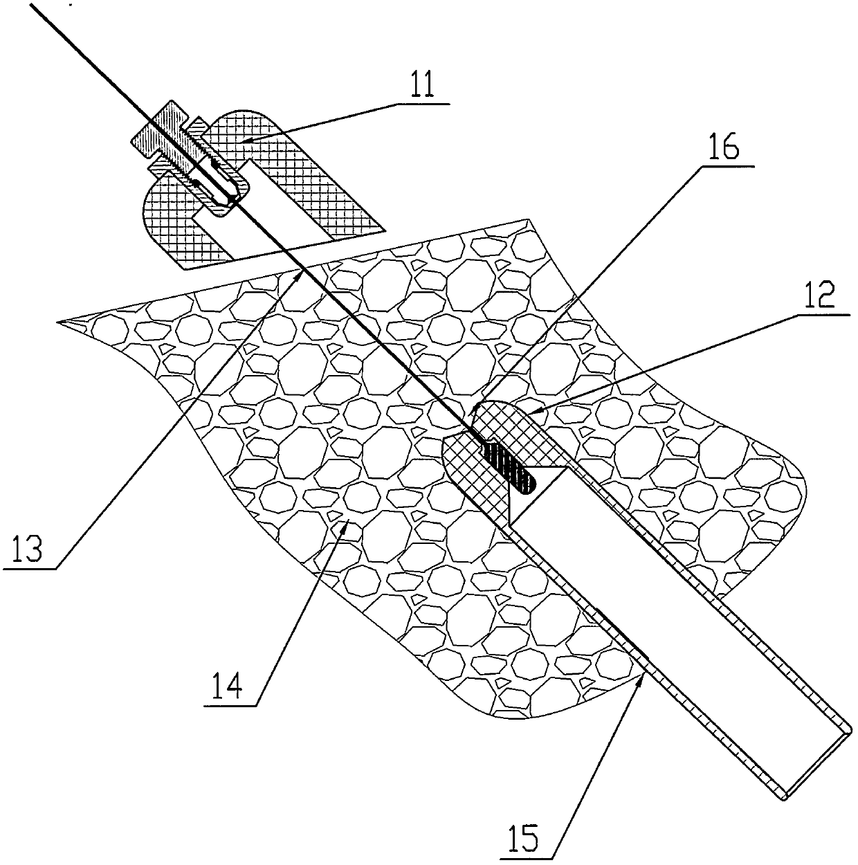 A surgical instrument for vaginal shaping