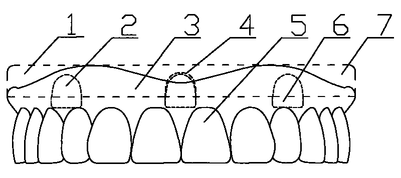 Upper jaw complete denture