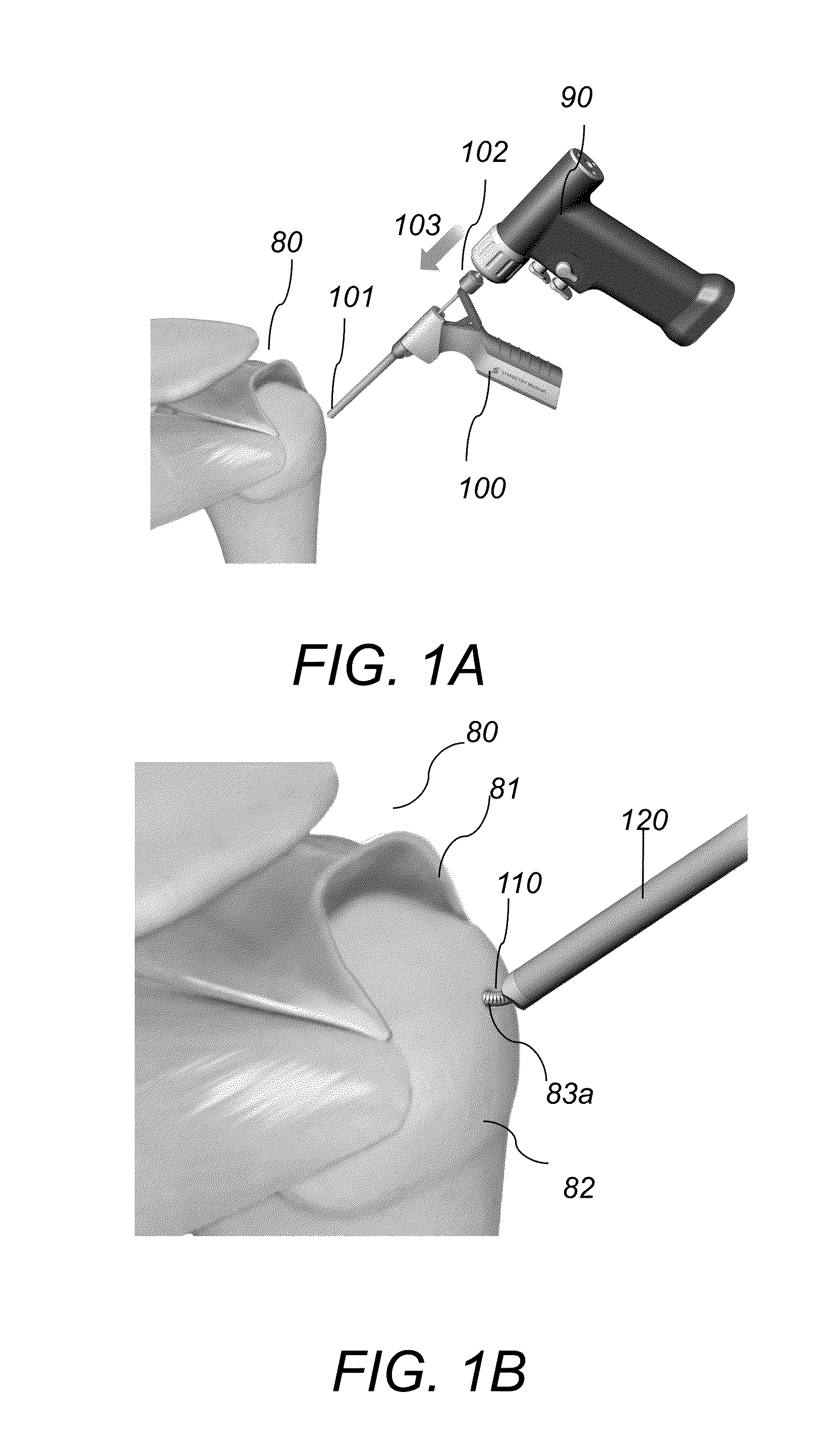 System and method for forming a curved tunnel in bone