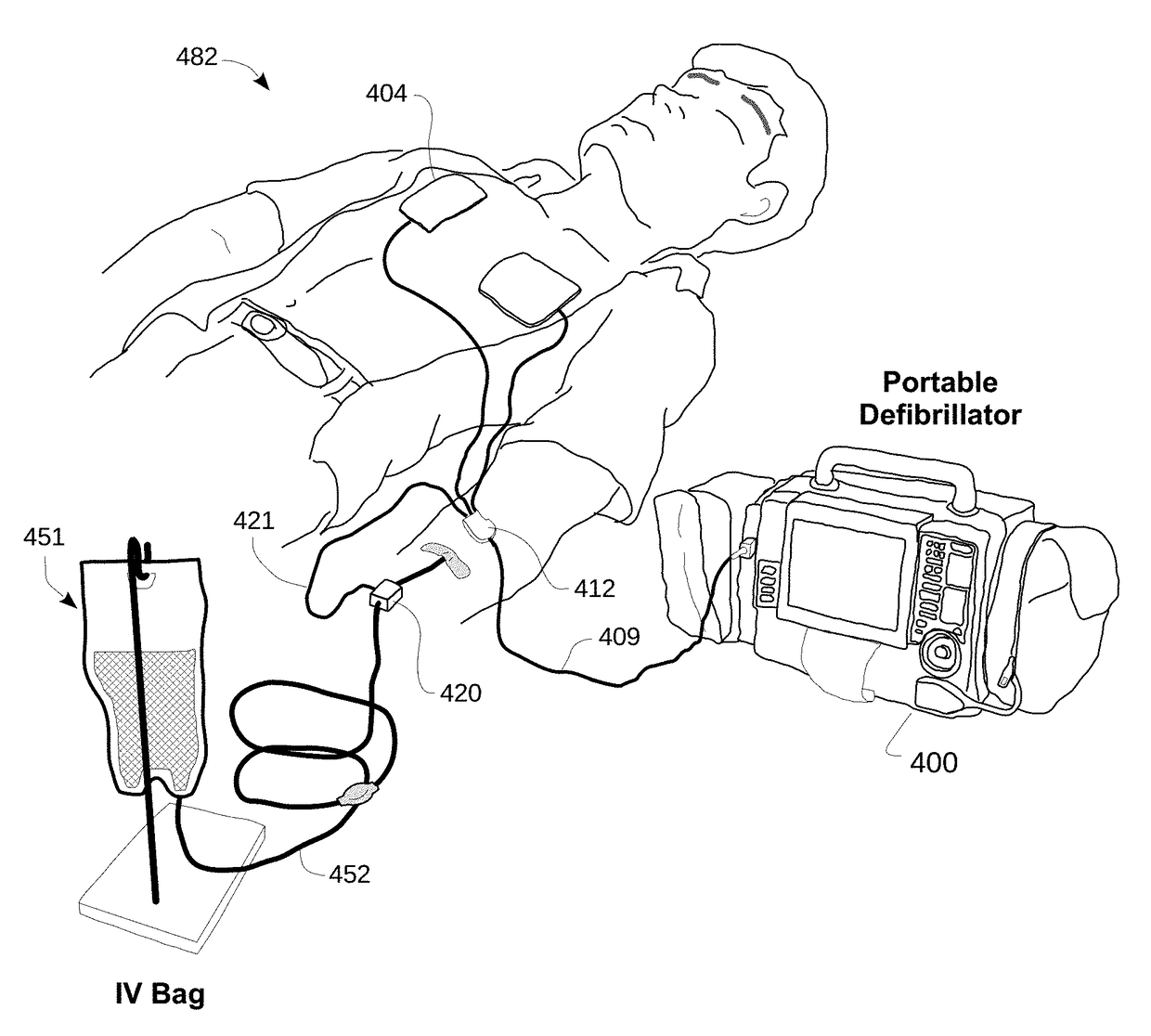 Intravenous line flow sensor for advanced diagnostics and monitoring in emergency medicine