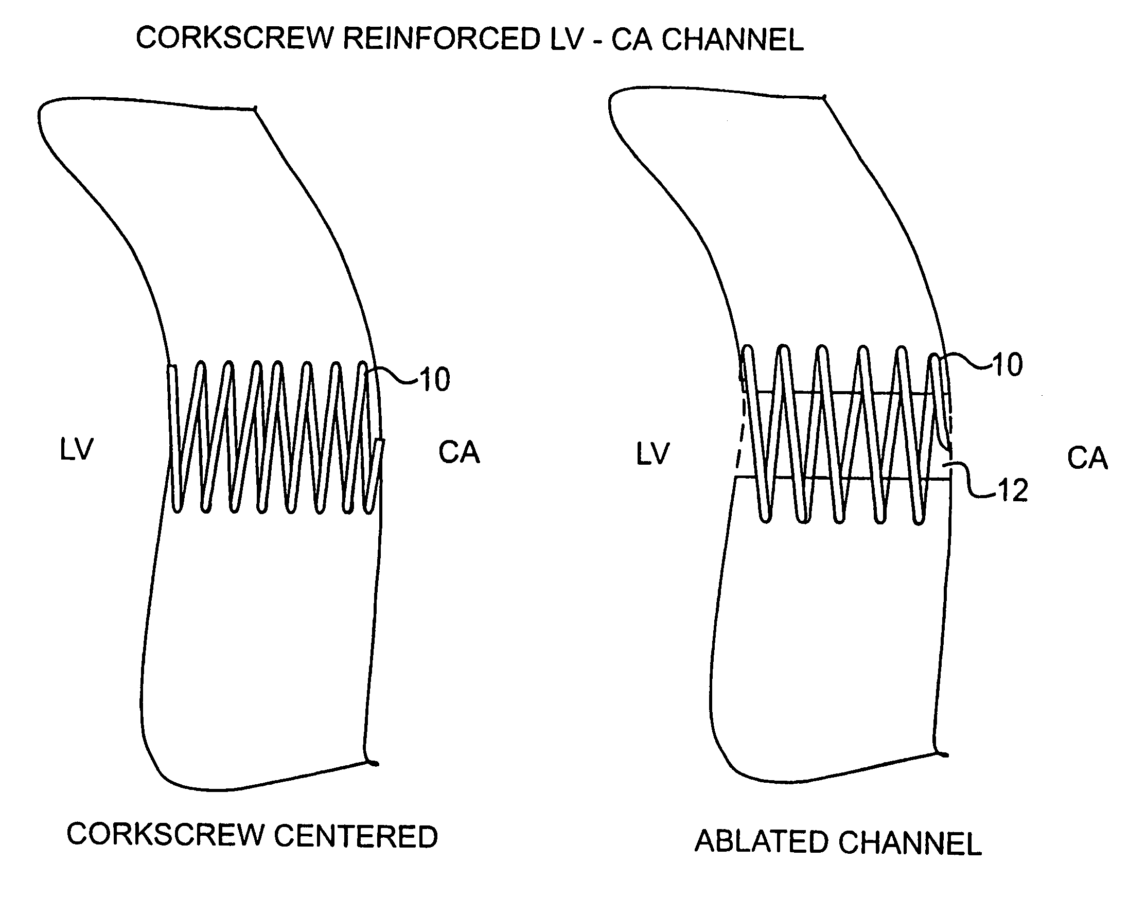 Corkscrew reinforced left ventricle to coronary artery channel