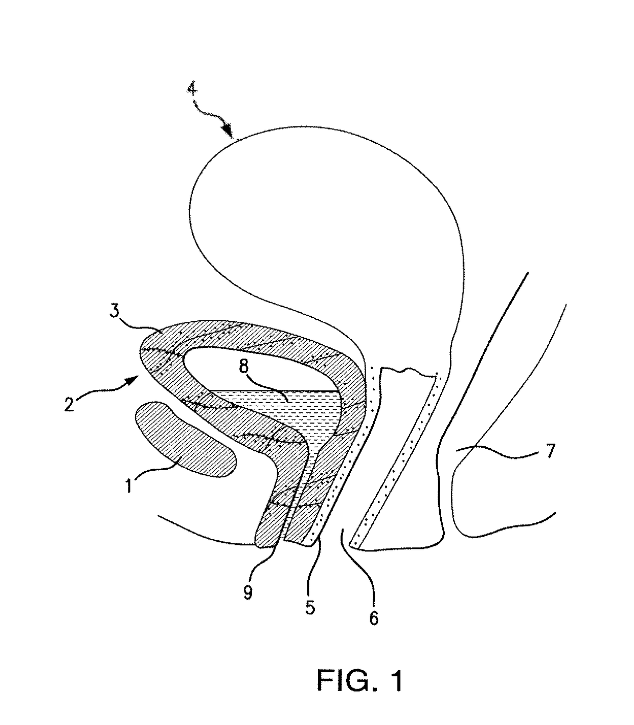 Treatment for vesicovaginal fistula