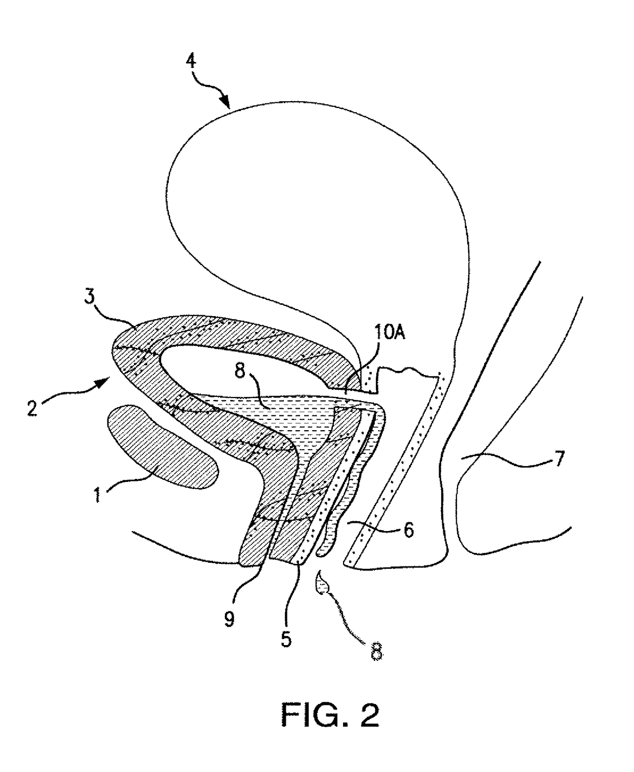 Treatment for vesicovaginal fistula