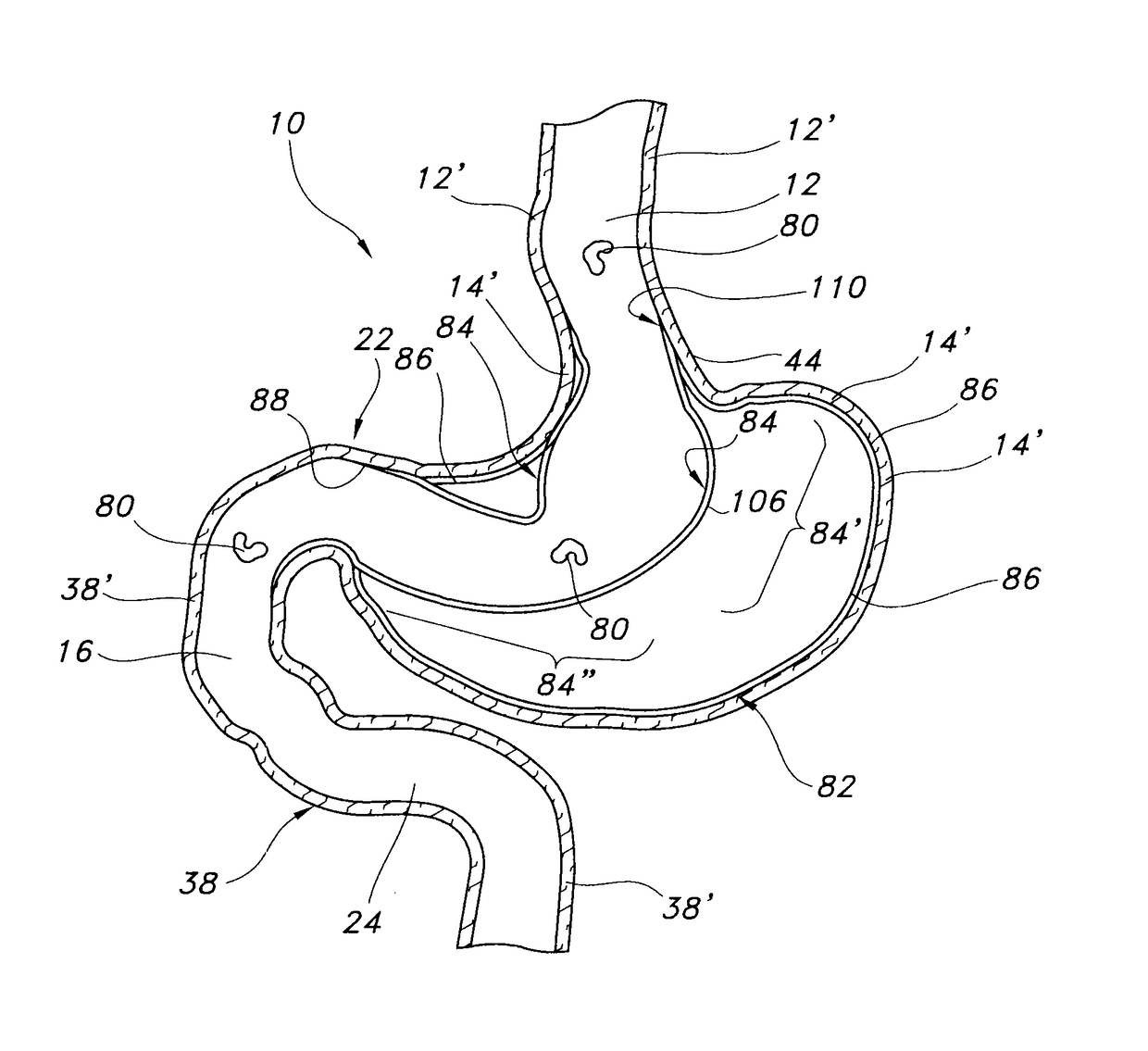 Stomach bypass for the treatment of obesity