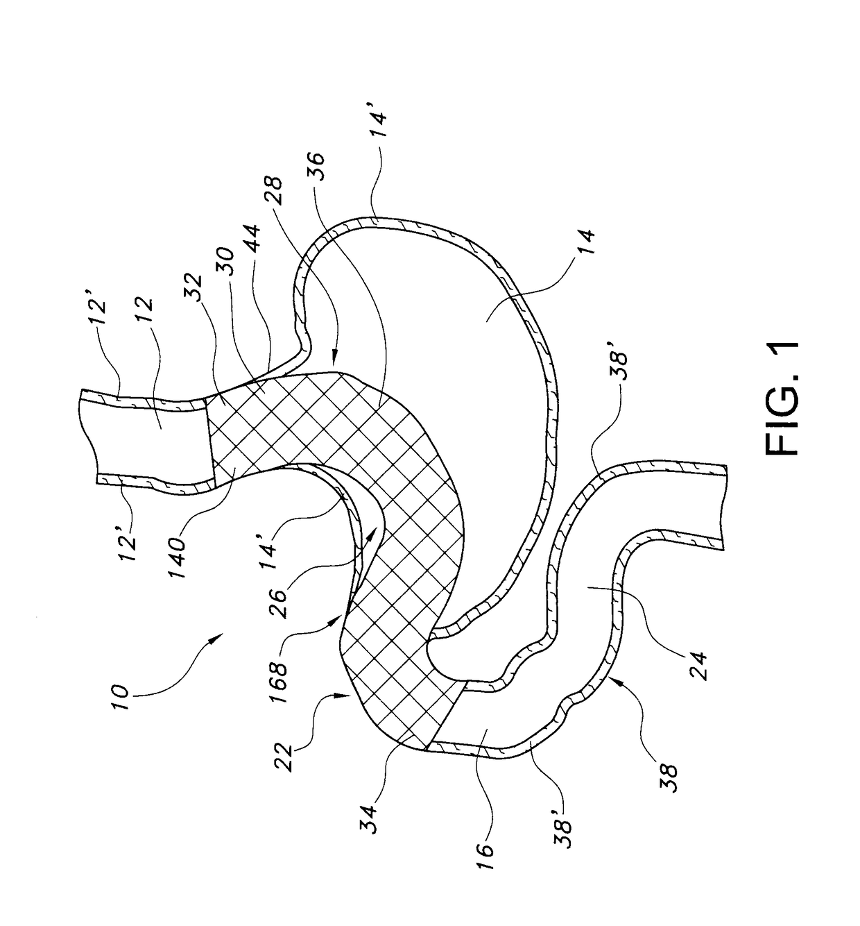 Stomach bypass for the treatment of obesity