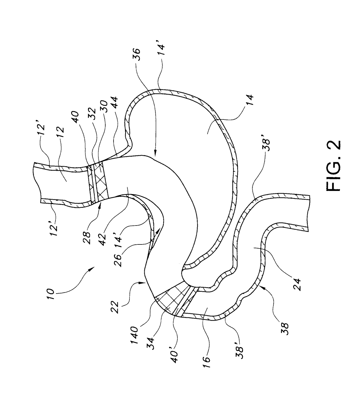 Stomach bypass for the treatment of obesity