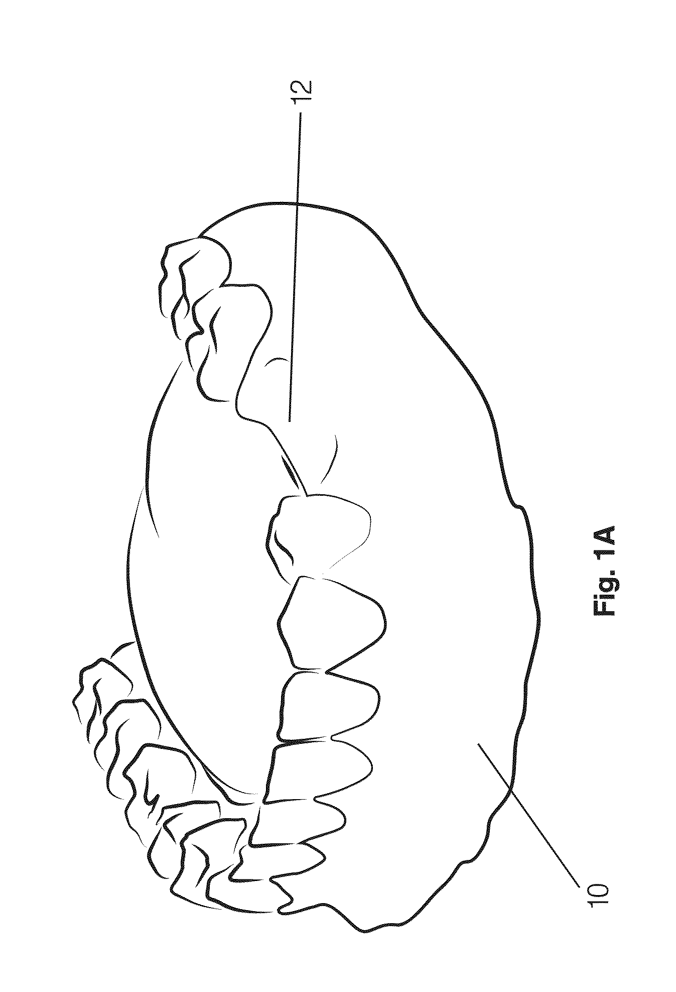 Guided drill, kit of guided drills and methods of osteotomy for inserting a dental implant using the kit