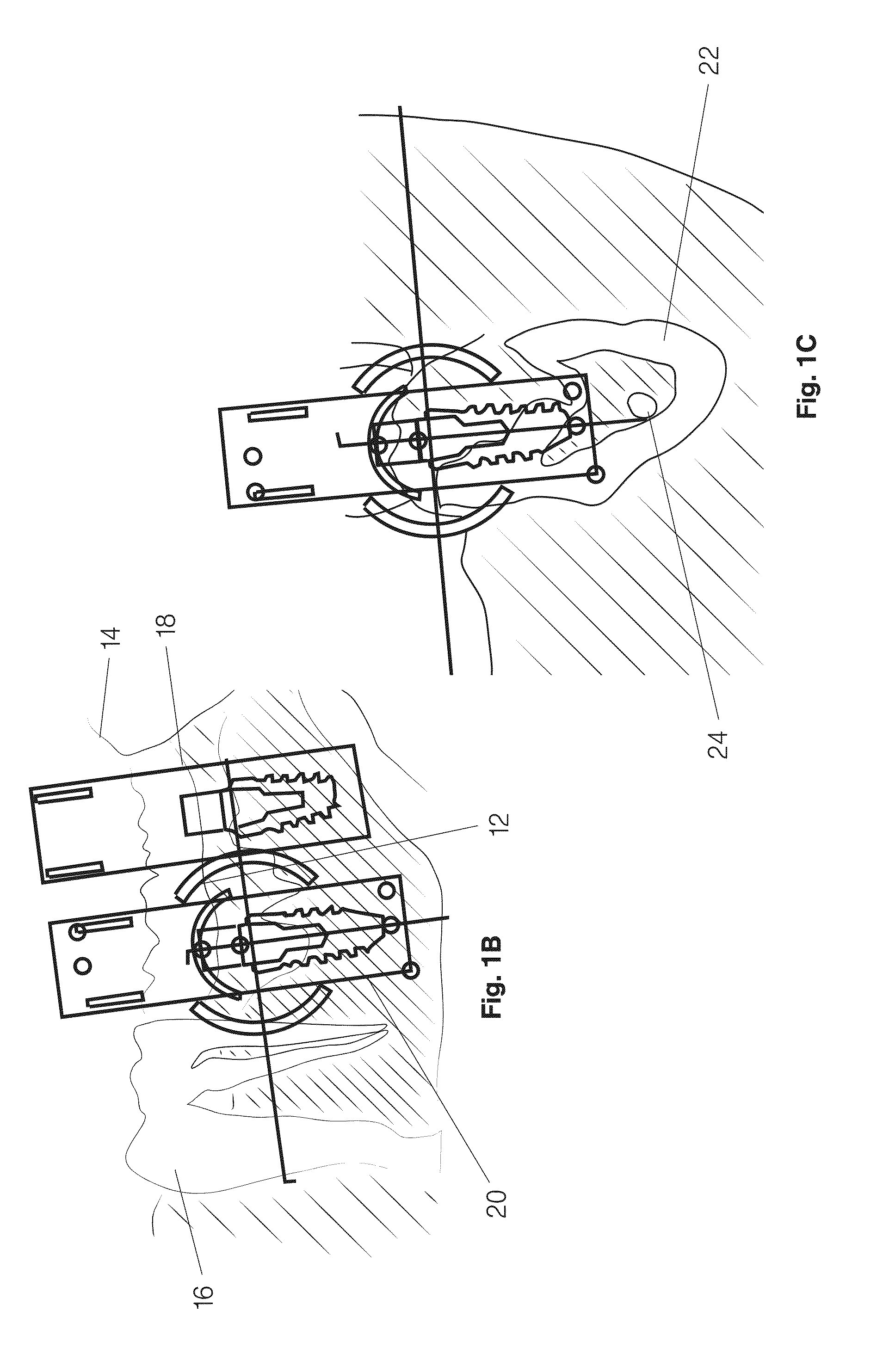 Guided drill, kit of guided drills and methods of osteotomy for inserting a dental implant using the kit