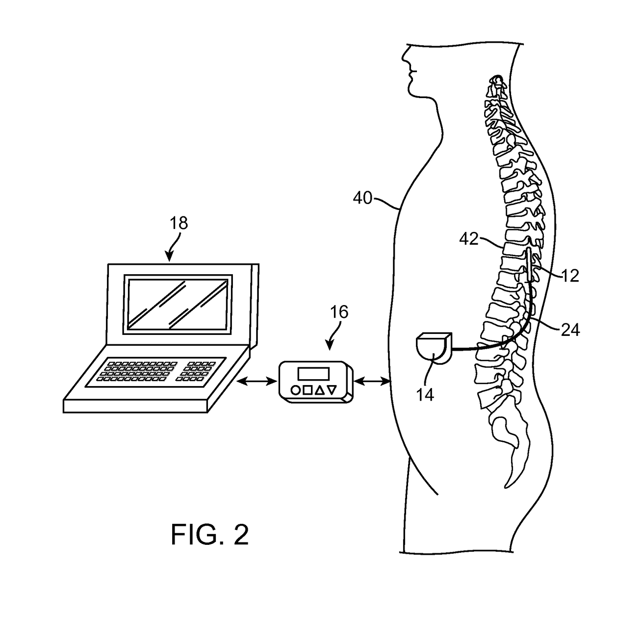 Systems and method for automatically detecting an MRI environment for patient implanted with medical device