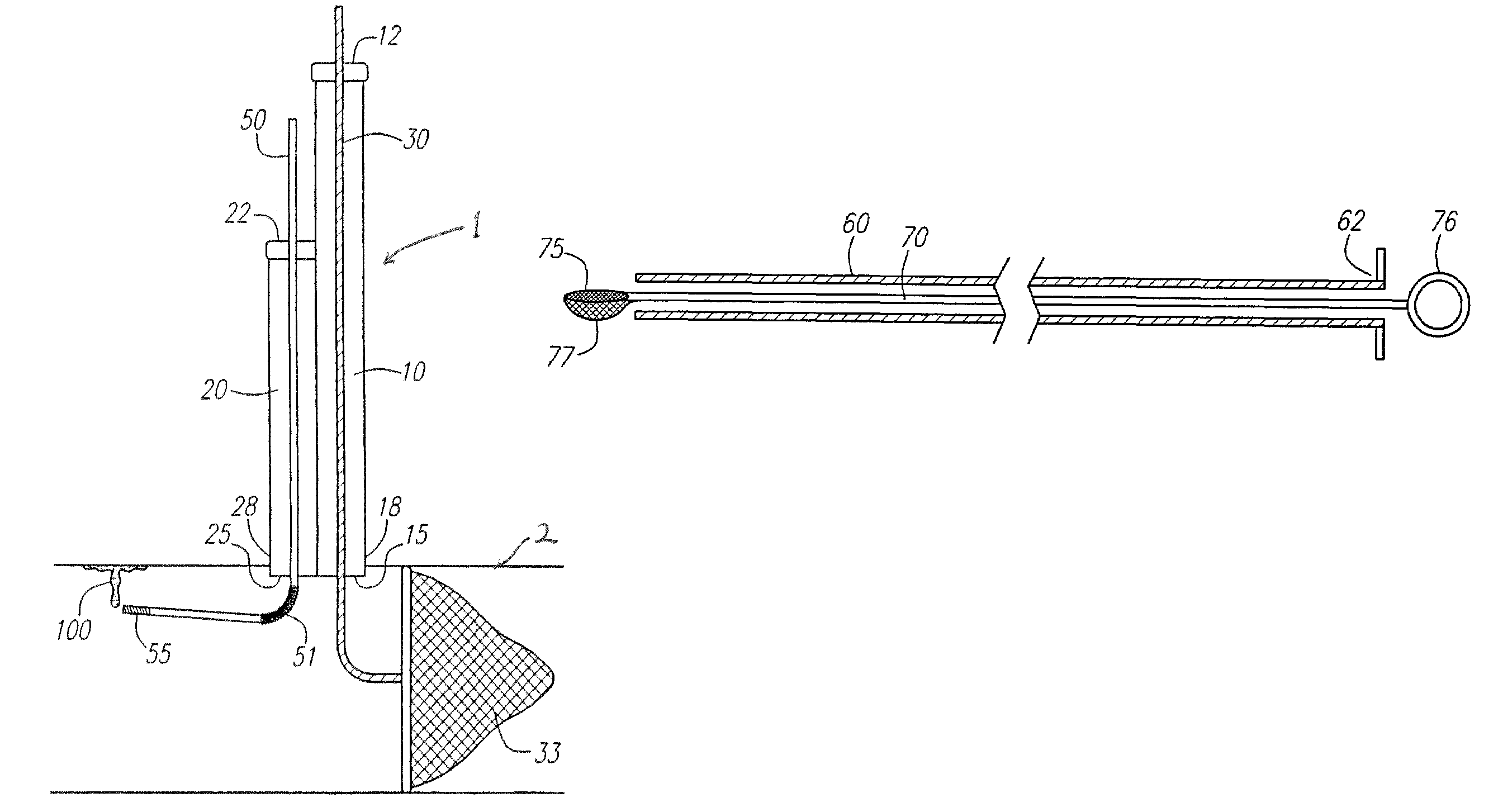 Direct access atherectomy devices