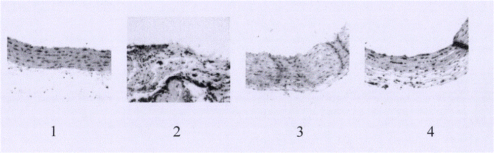 Pharmaceutical composition for preventing atherosclerosis and application thereof