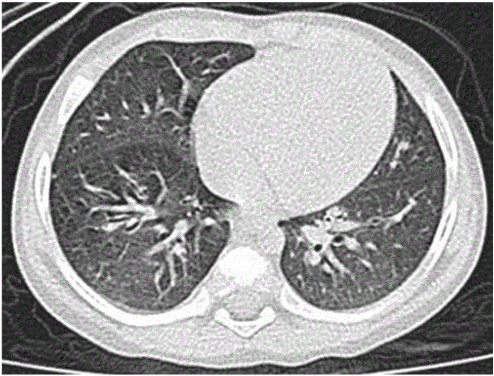 CFTR (Cystic Fibrosis Transmembrane Conductance Regulator) gene deletion mutation form of cystic fibrosis patients and application of CFTR gene deletion mutation form