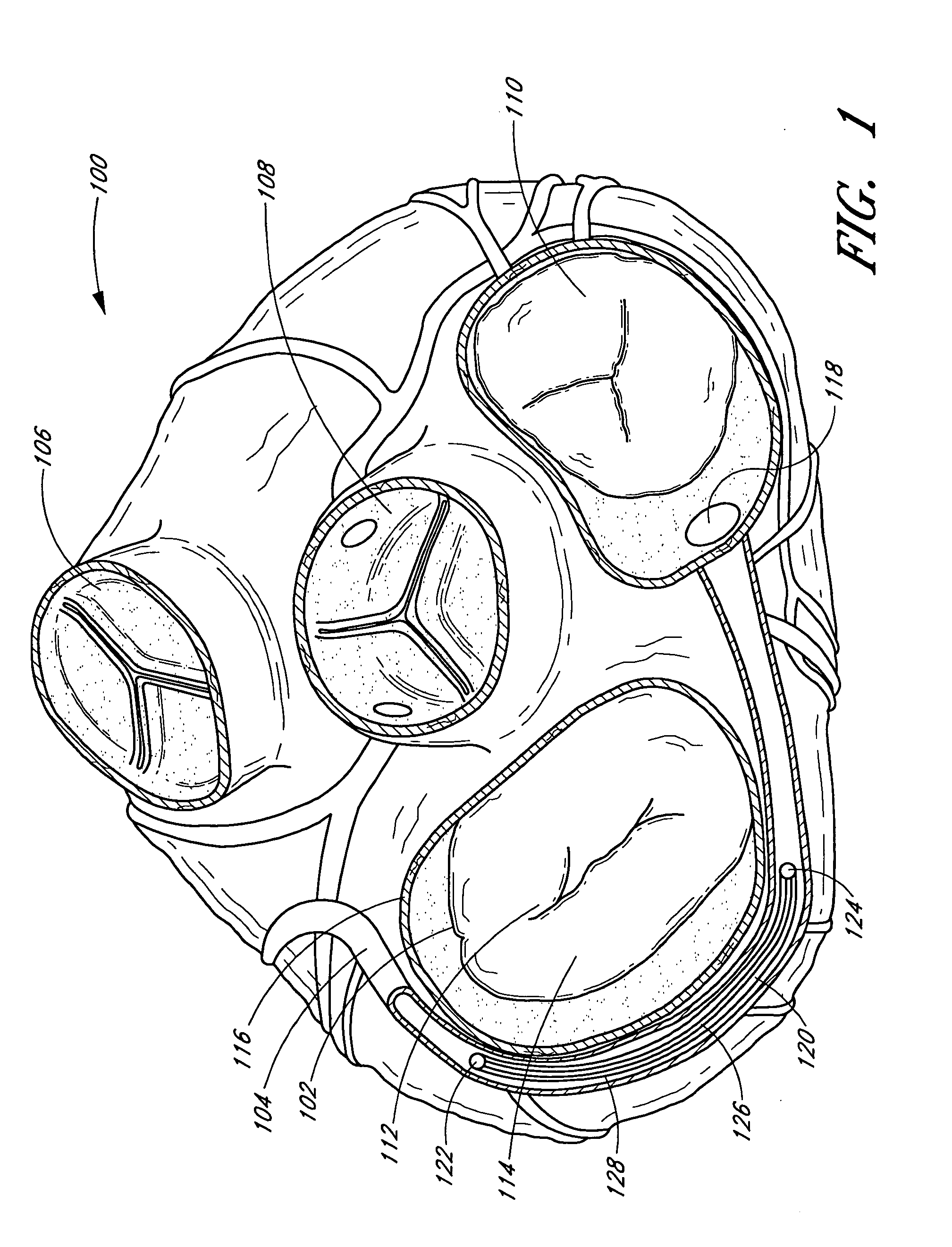 Magnetic implants and methods for reshaping tissue