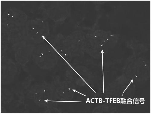 Probe assembly for diagnosing ACTB-TFEB translocation renal carcinoma and application thereof