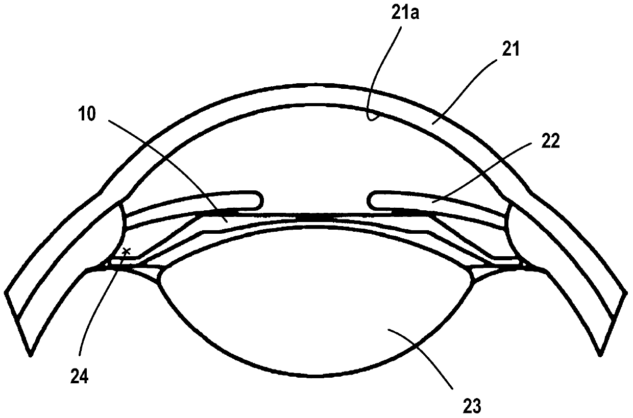 Phakic intraocular lens