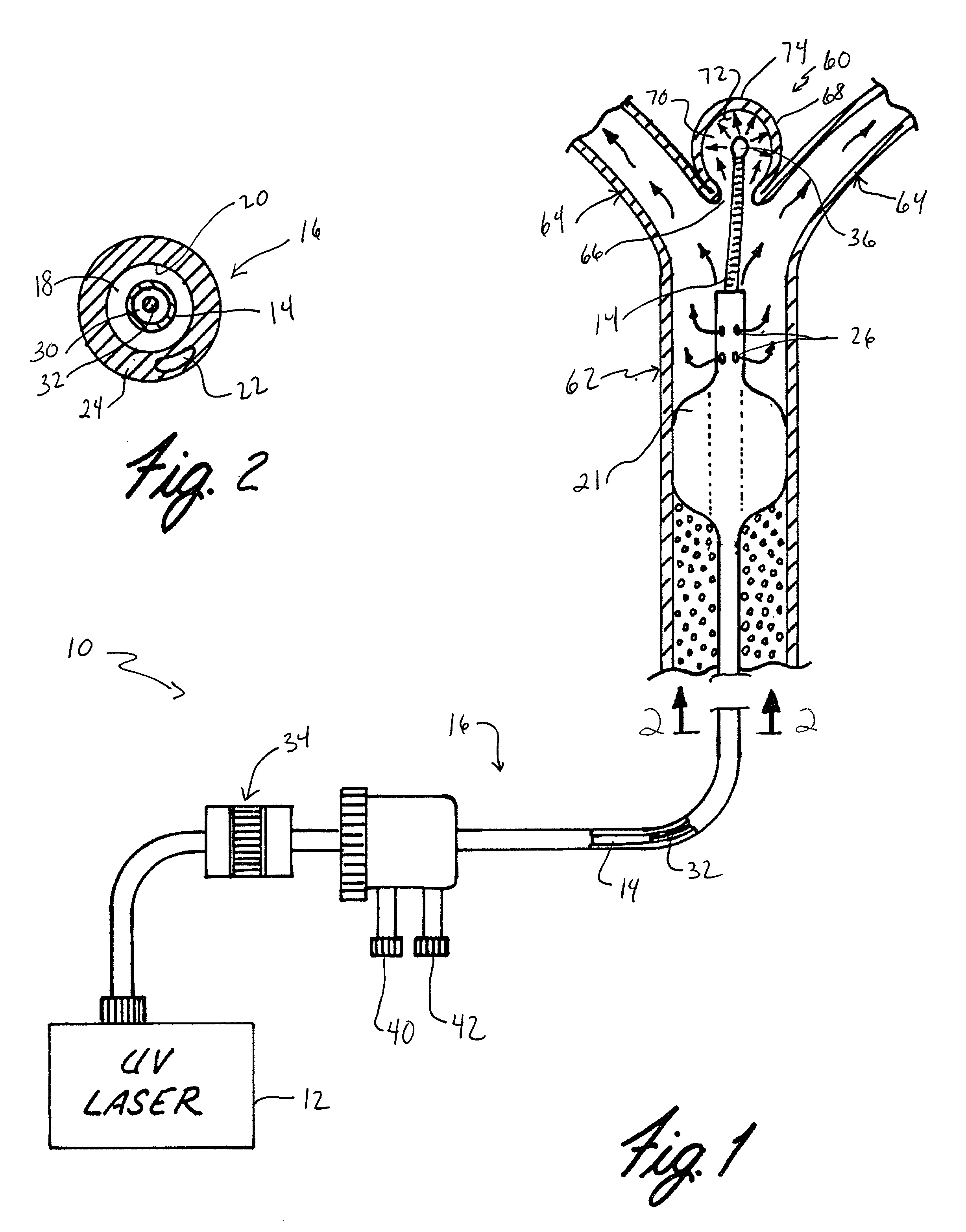 Apparatus and method for treatment of cerebral aneurysms, arterial-vascular malformations and arterial fistulas