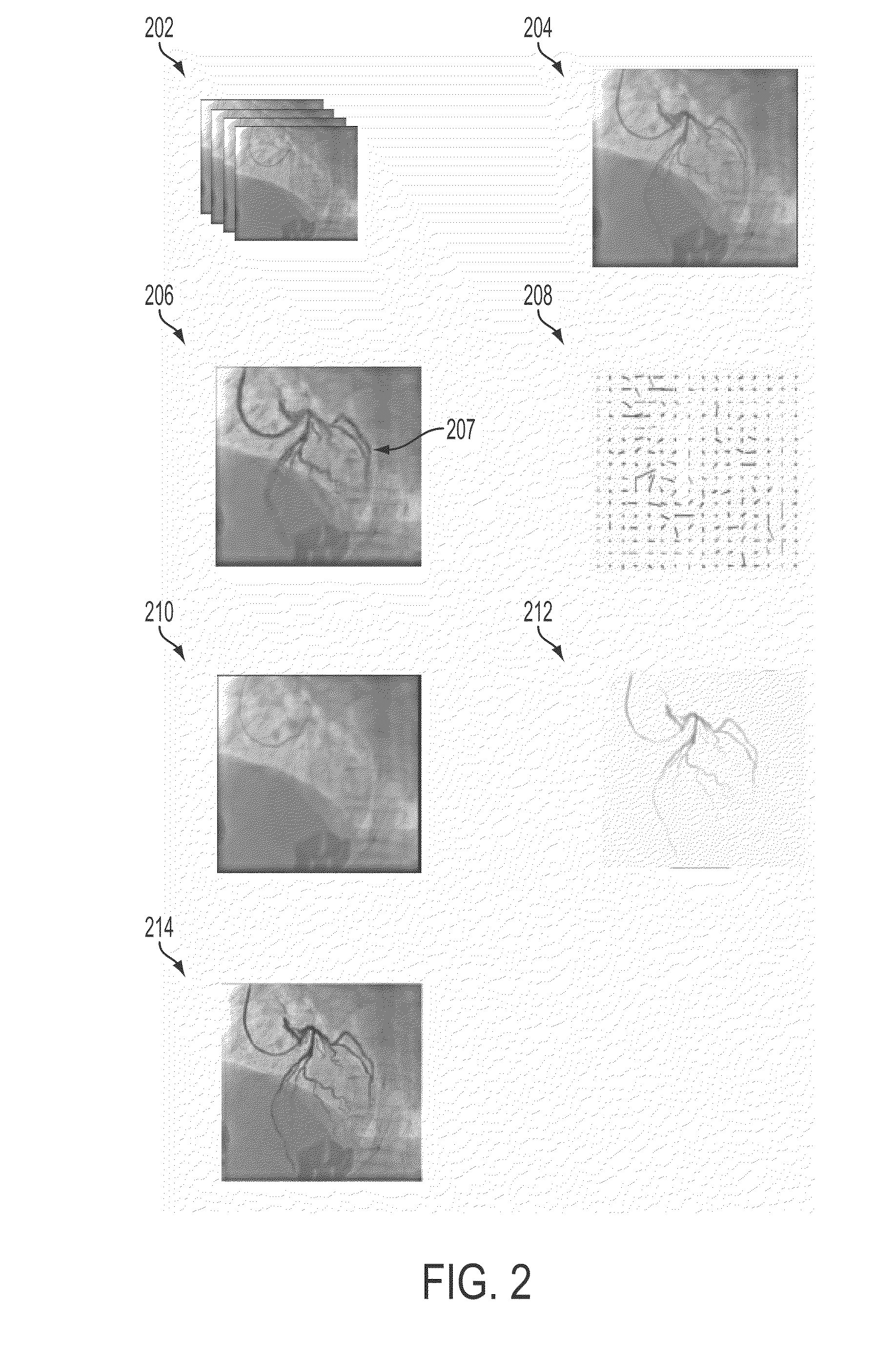 System and Method for Coronary Digital Subtraction Angiography