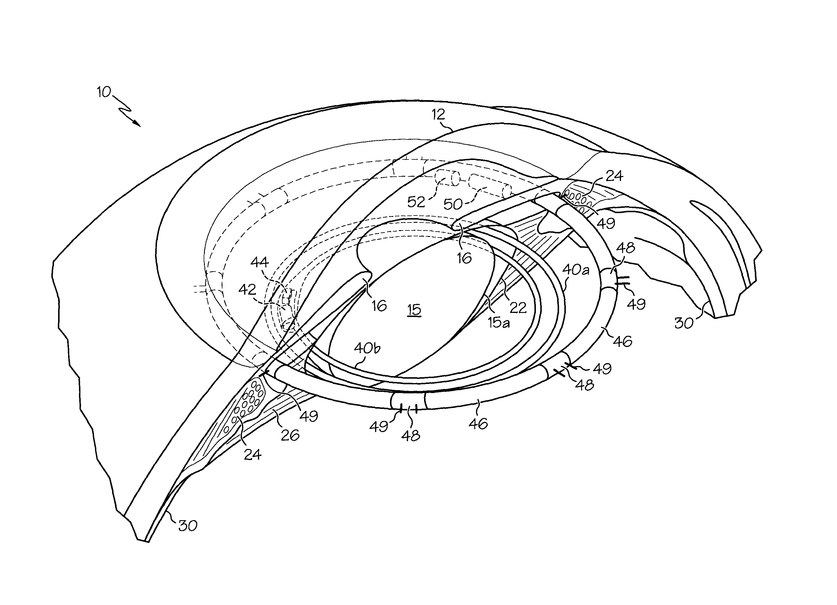 Accommodating intra-ocular lens system