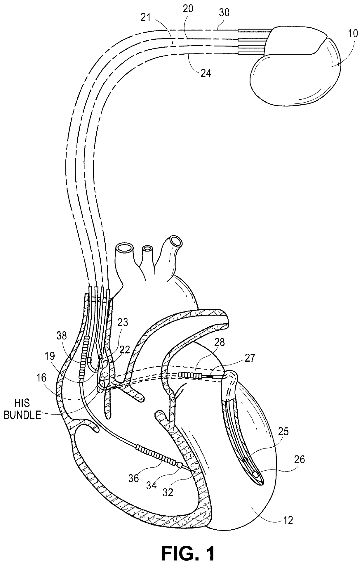 Time domain-based methods for his bundle capture classification