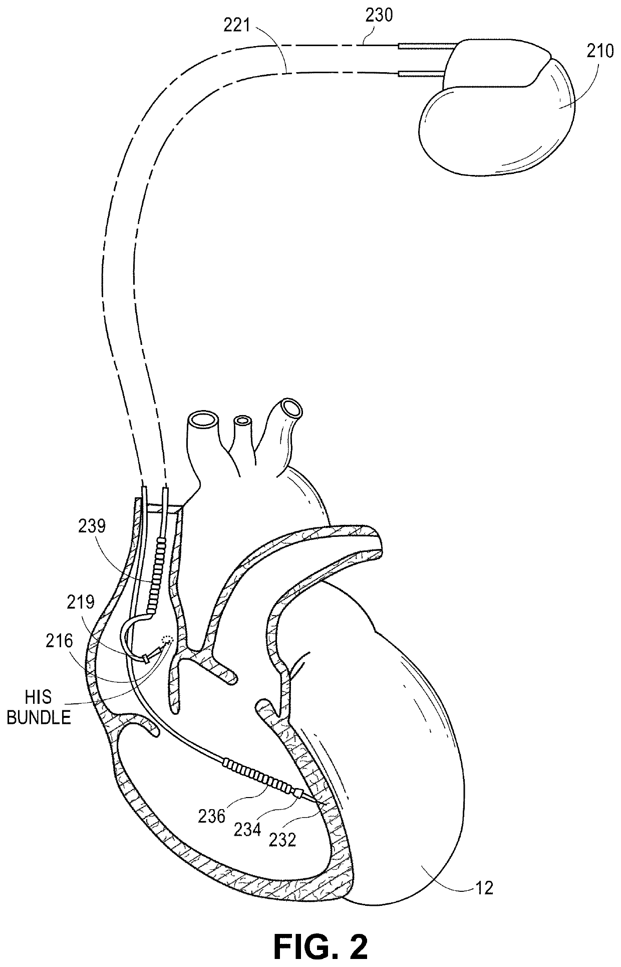 Time domain-based methods for his bundle capture classification