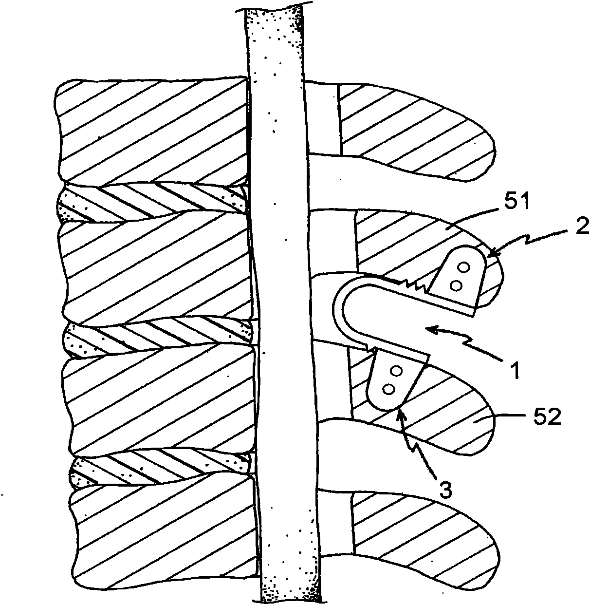 Spacing and stabilizing structure of convex ridges