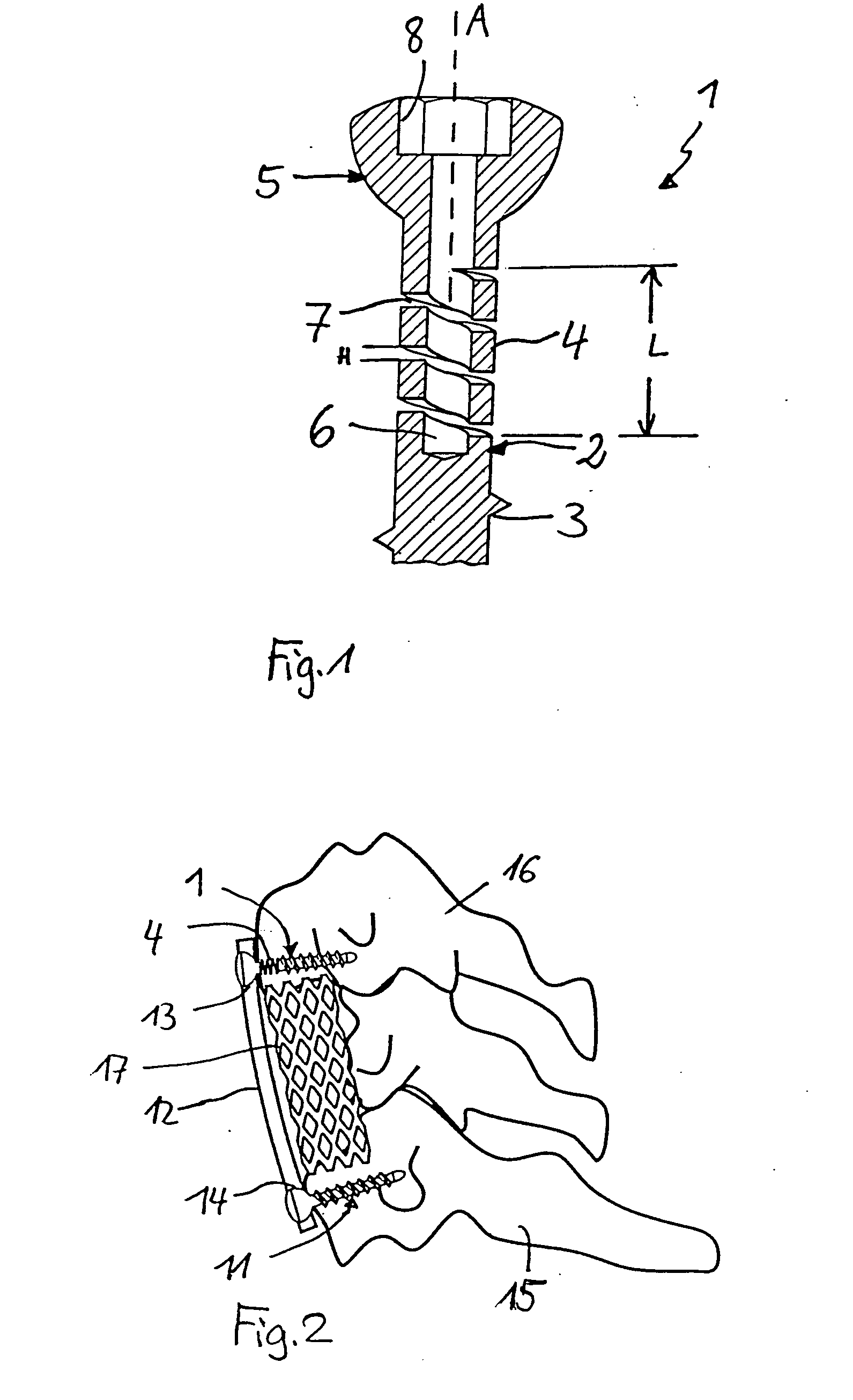 Stabilization device for bones comprising a spring element and manufacturing method for said spring element