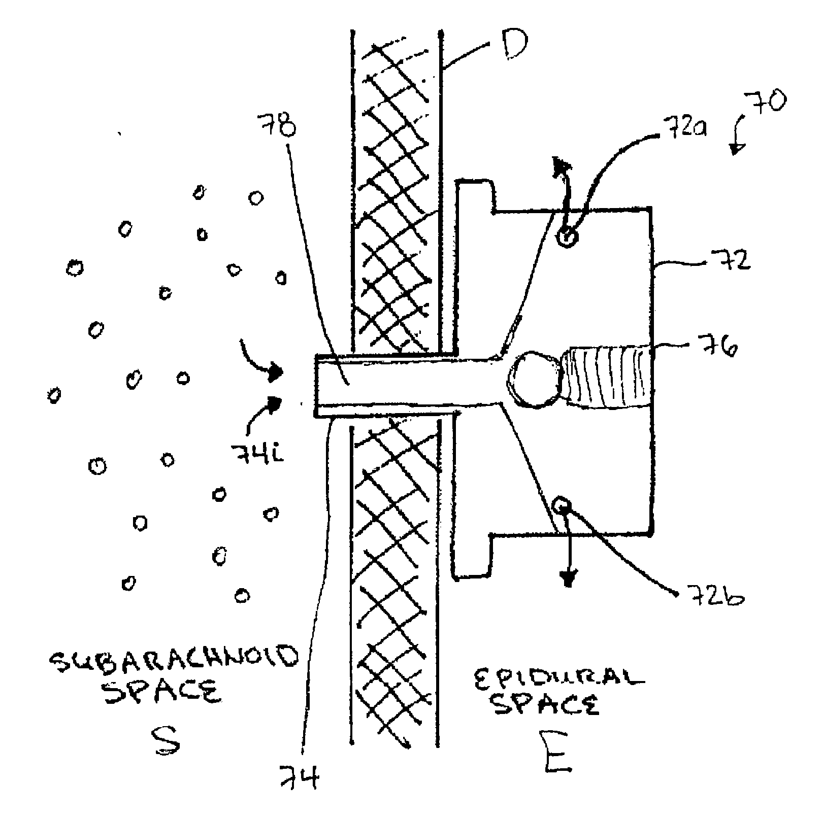 Subarachnoid epidural shunt