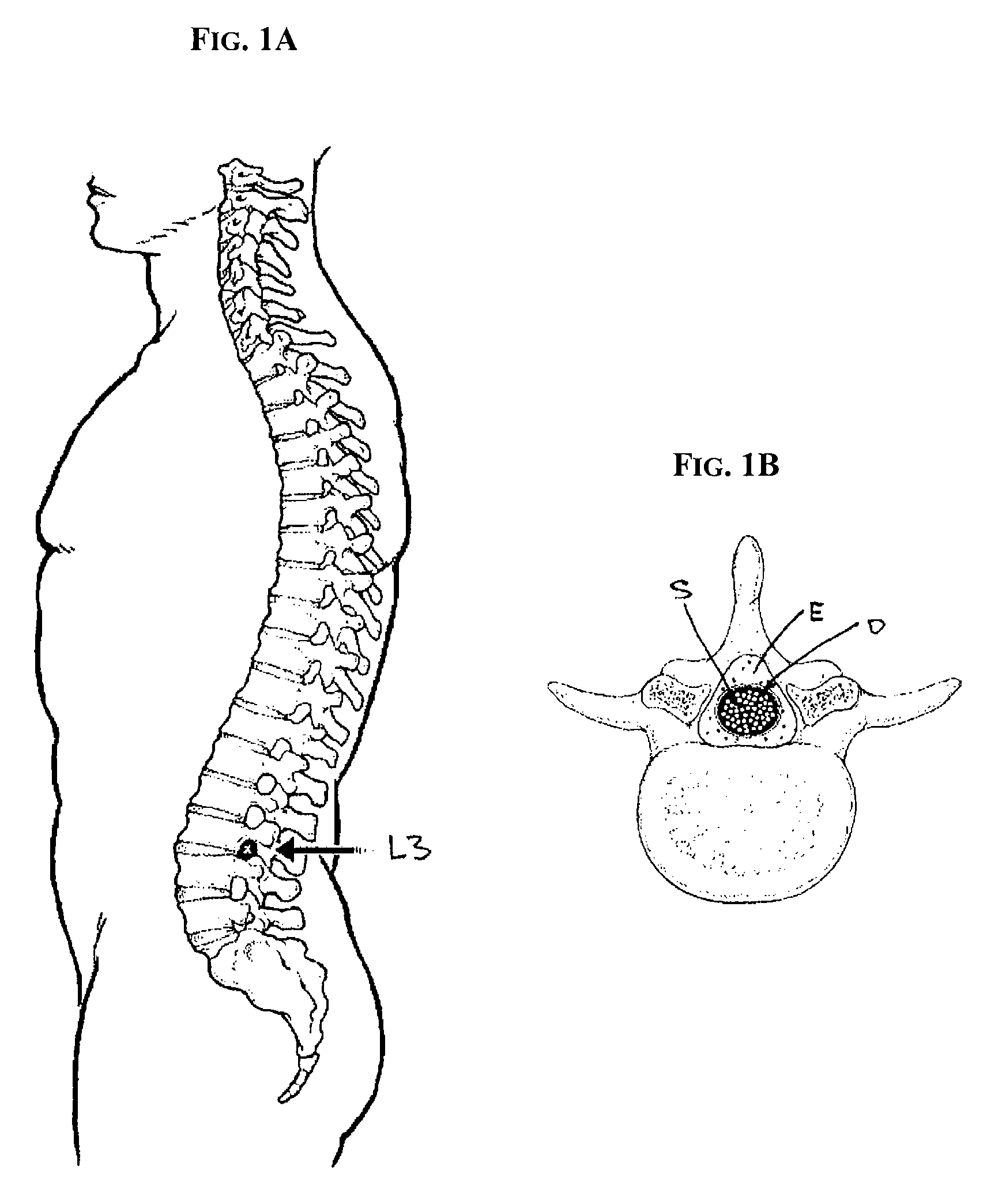 Subarachnoid epidural shunt