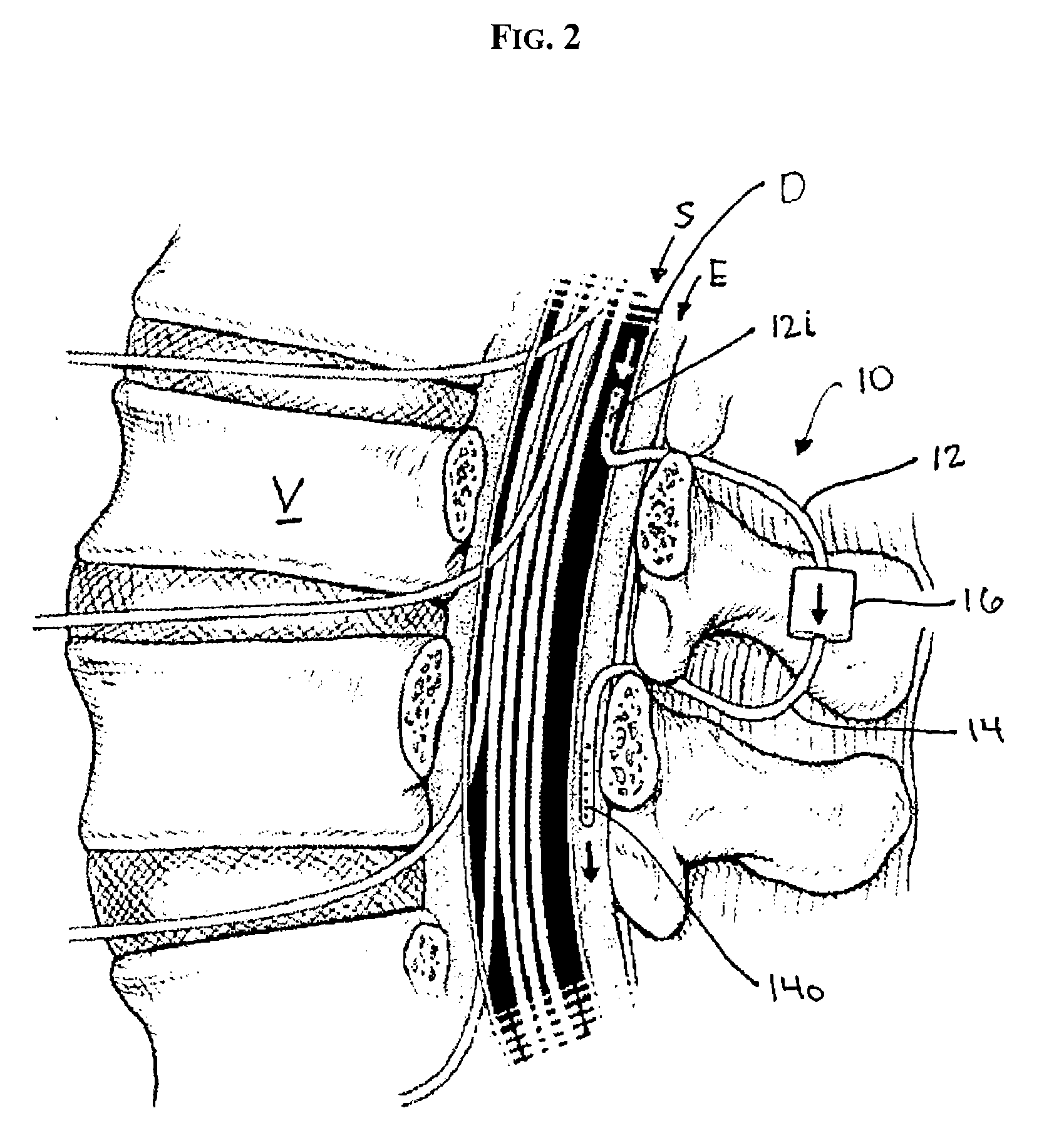 Subarachnoid epidural shunt