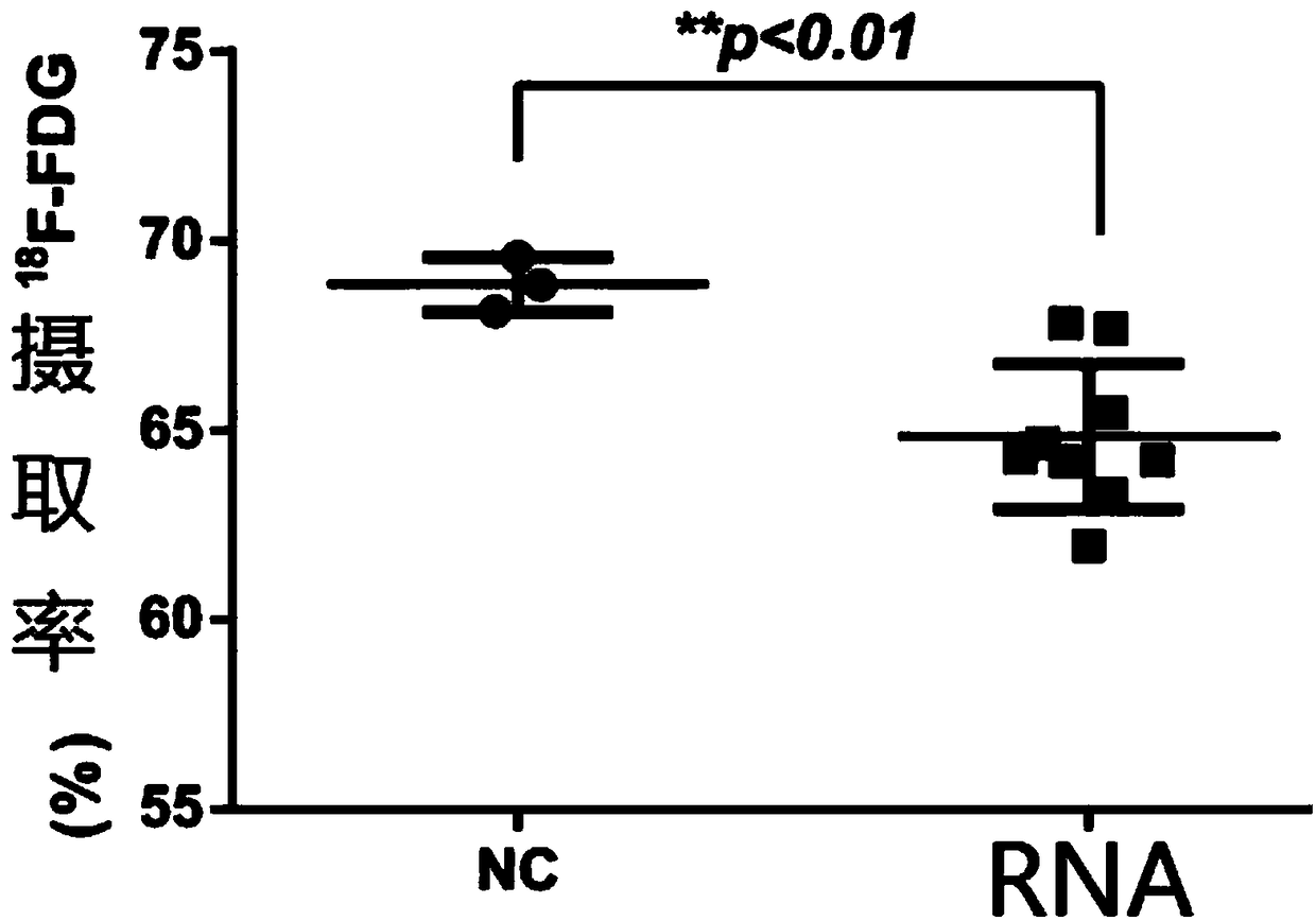 Tumor cell sugar uptake inhibitor and application thereof