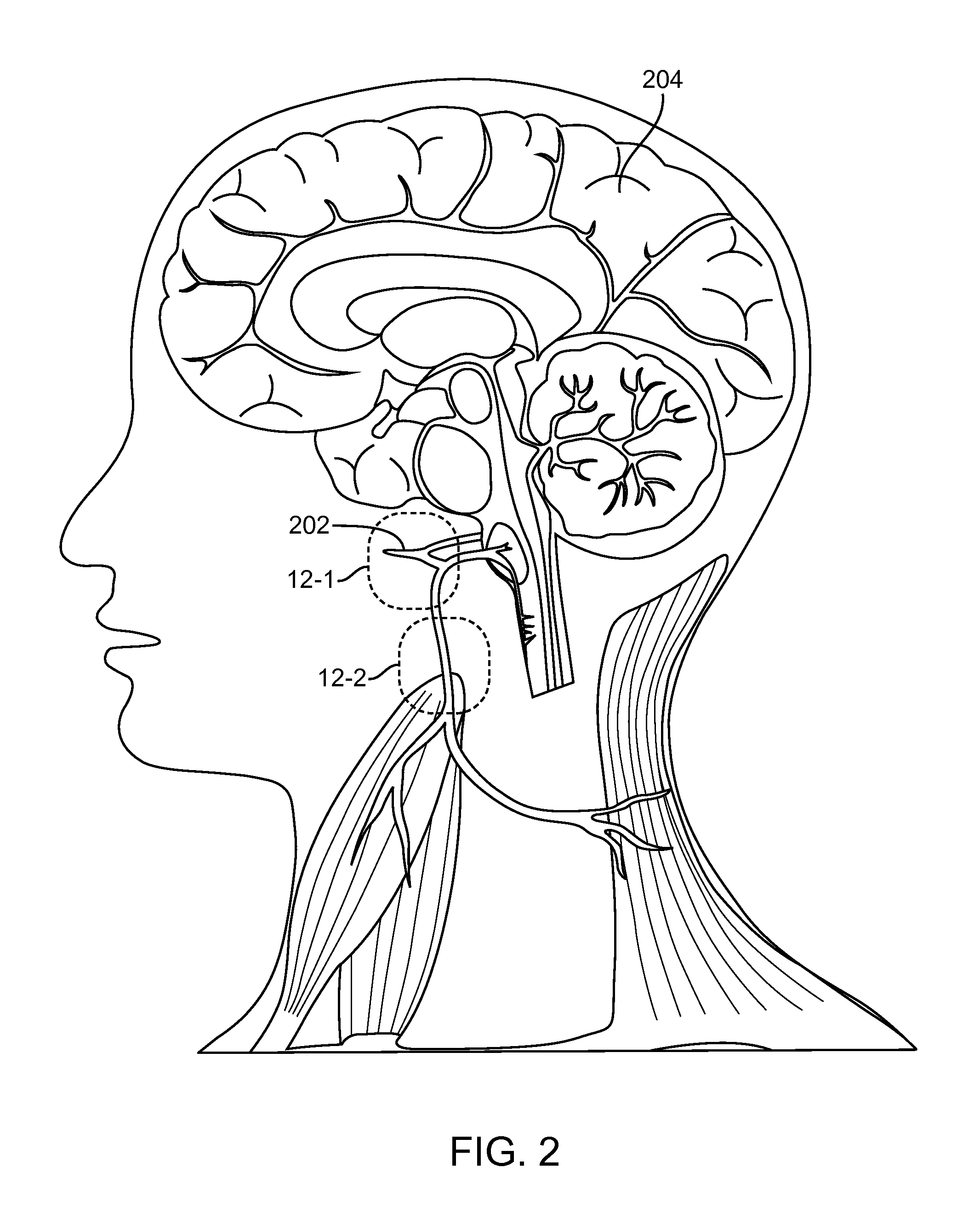 Transcutaneous electrical stimulation for treating neurological disorders