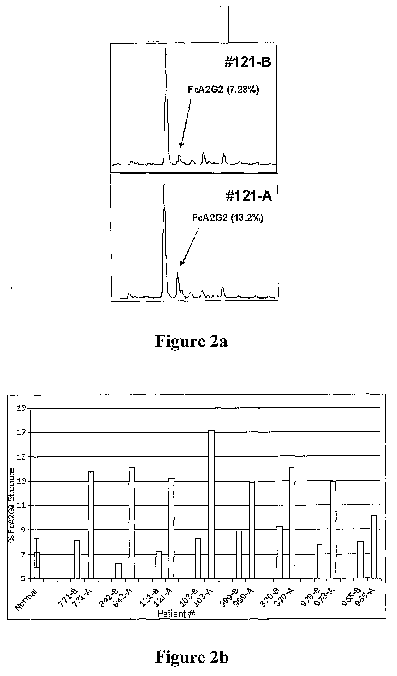 Diagnosis of liver pathology through assessment of protein glycosylation