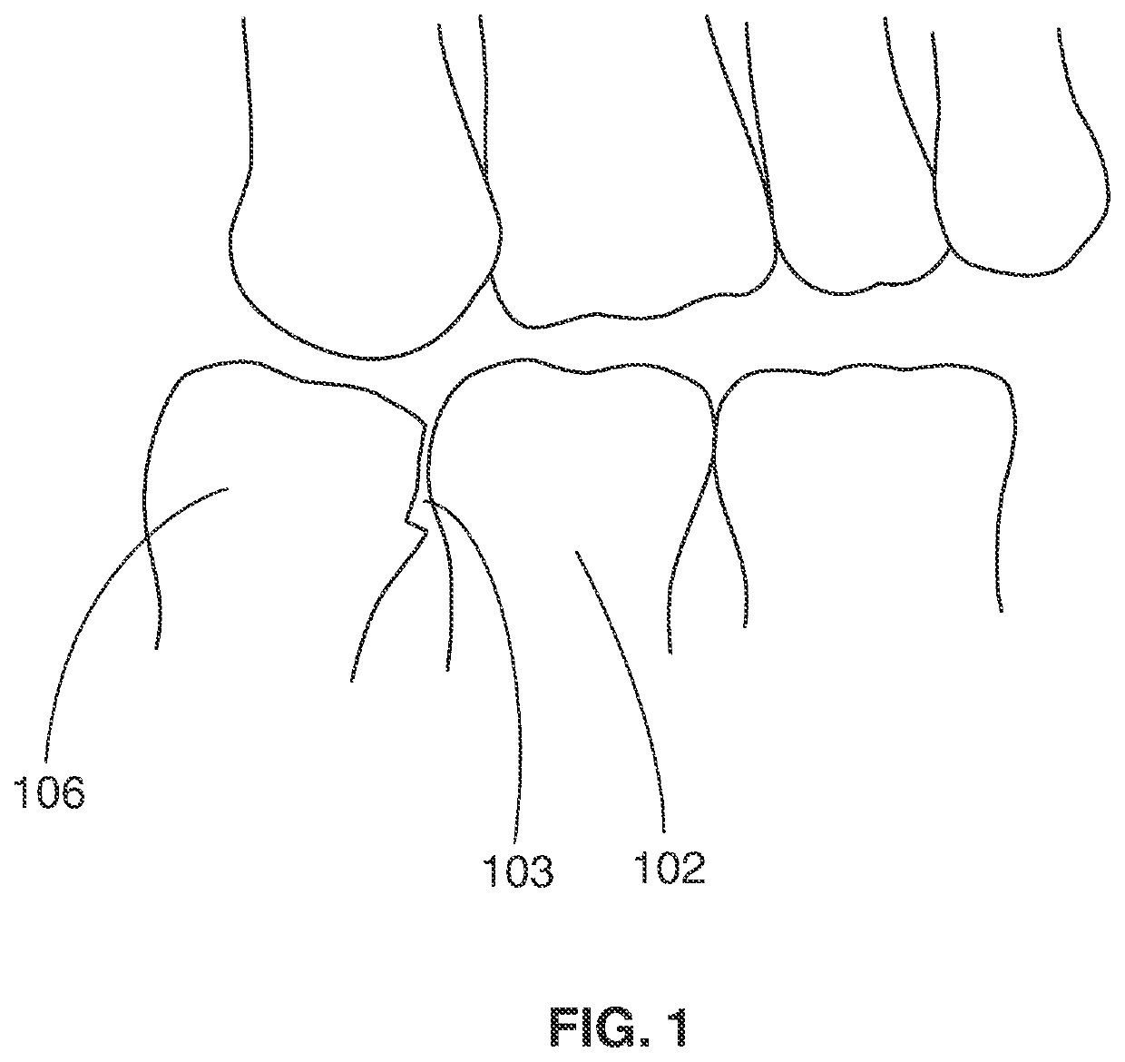 Interproximal Reduction Tool And Method