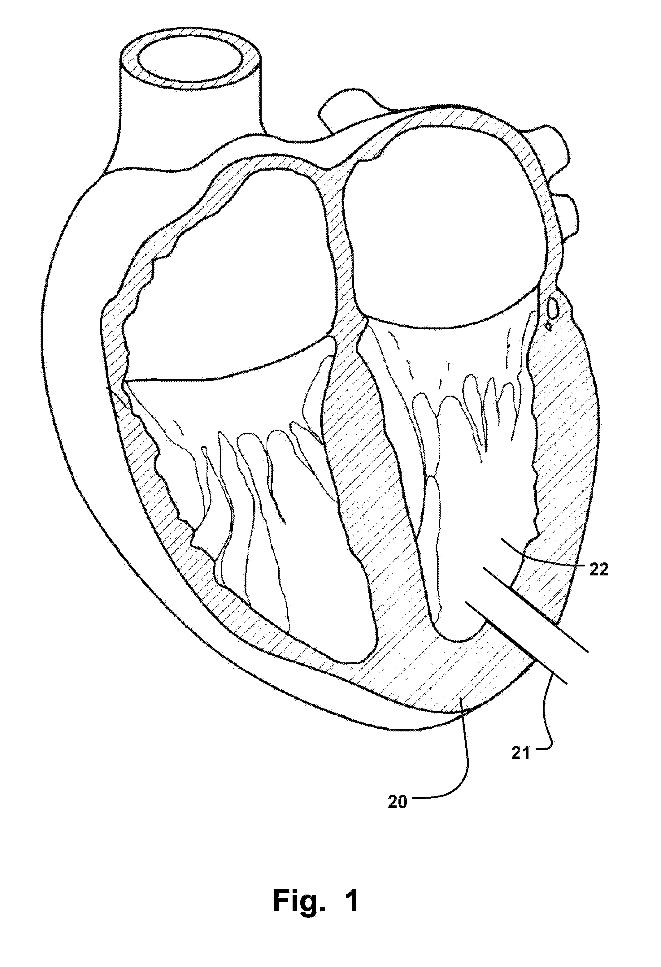 Medical Occlusion Device