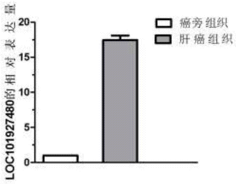 Use of lncRNA as biomarker in diagnosis and treatment of liver cancer