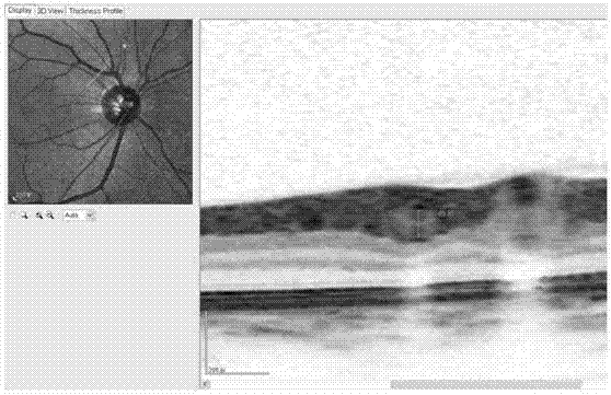 Method for measuring retinal blood vessel diameter and thickness of vessel wall