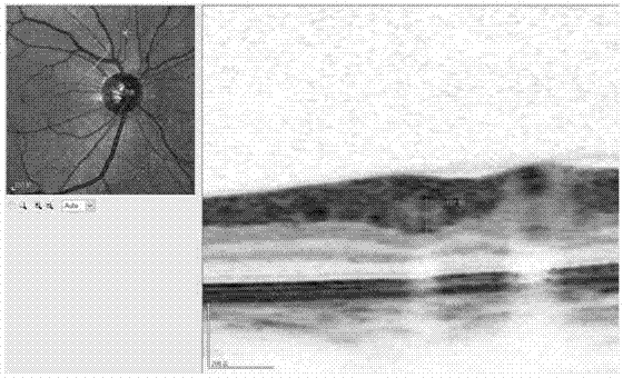 Method for measuring retinal blood vessel diameter and thickness of vessel wall