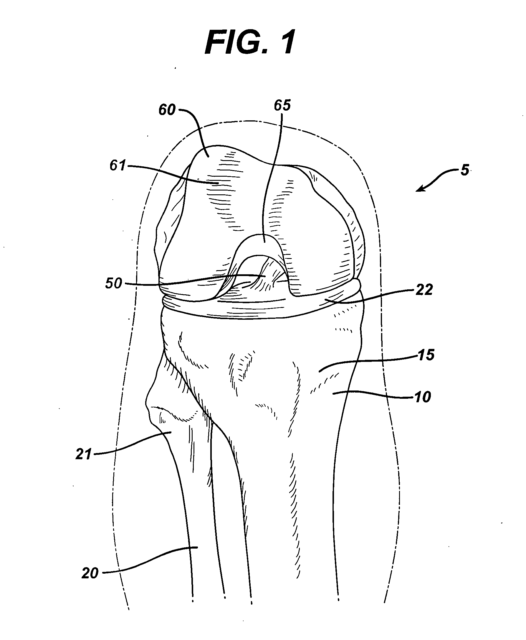 Method of replacing an anterior cruciate ligament in the knee