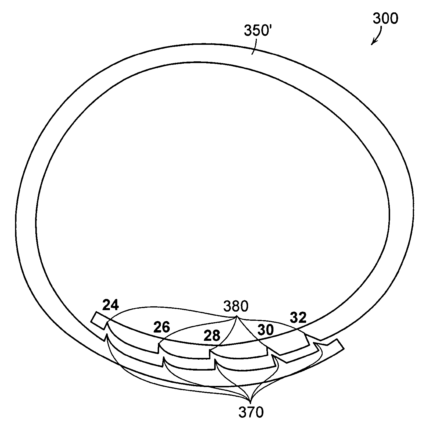 Mitral valve ring for treatment of mitral valve regurgitation