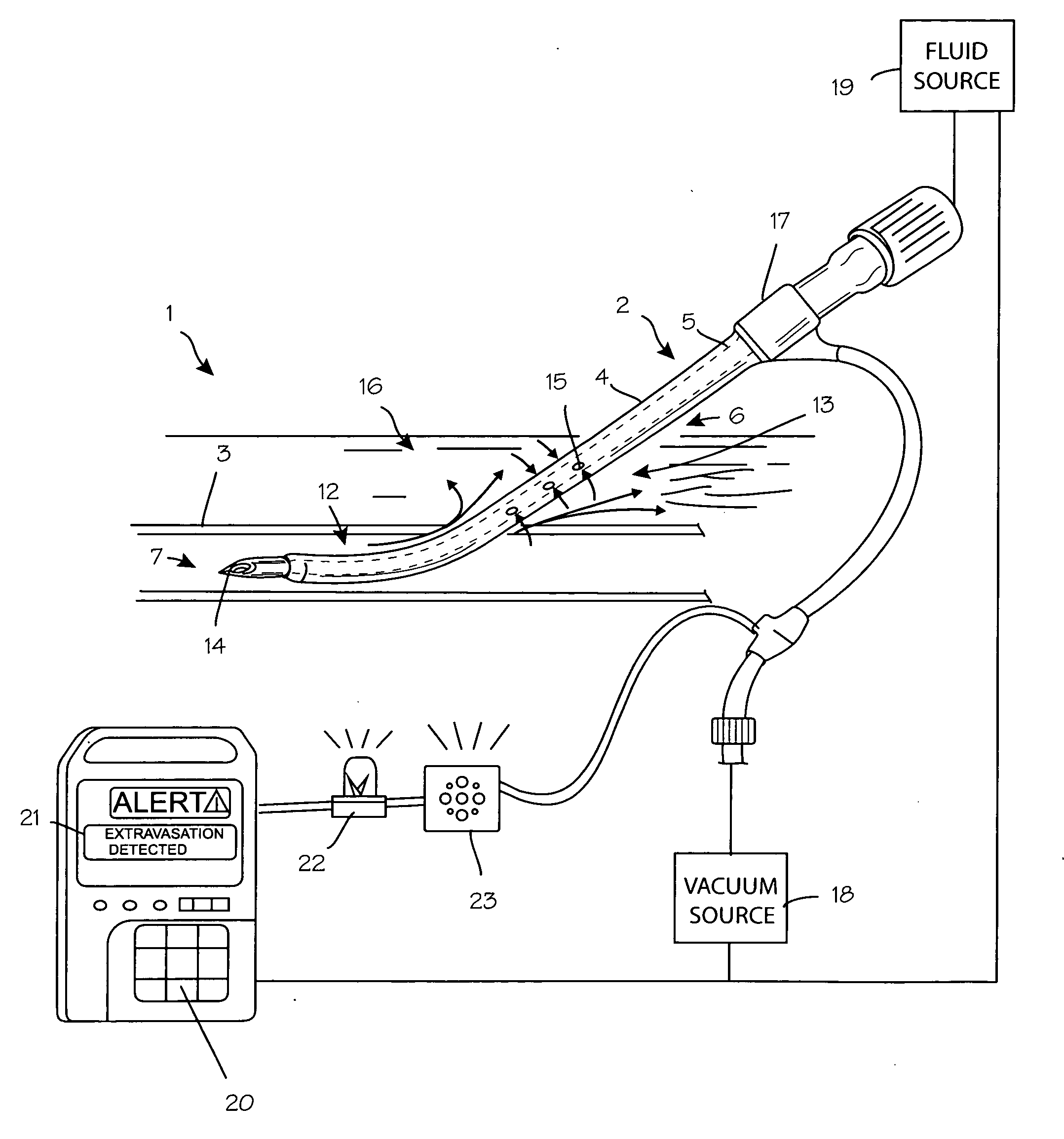 Anti-extravasation catheter