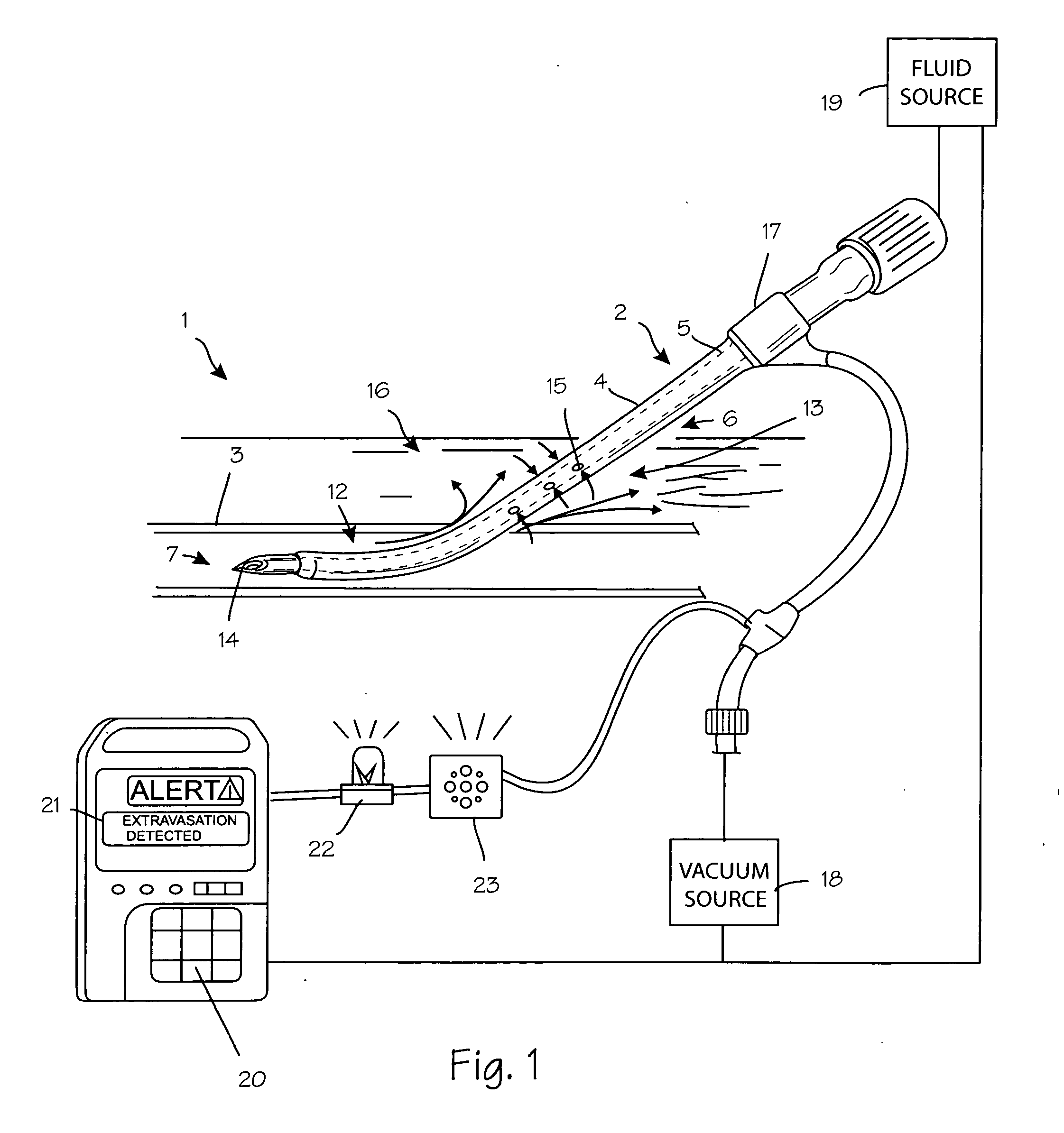 Anti-extravasation catheter