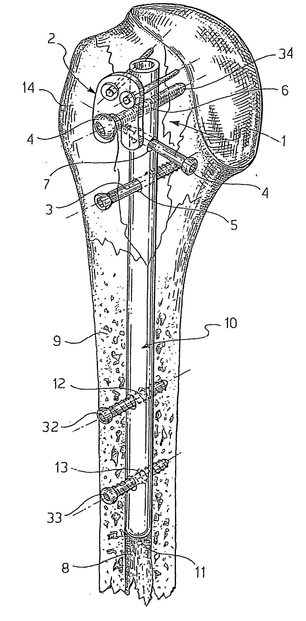 Surgical nail and screw fixation system