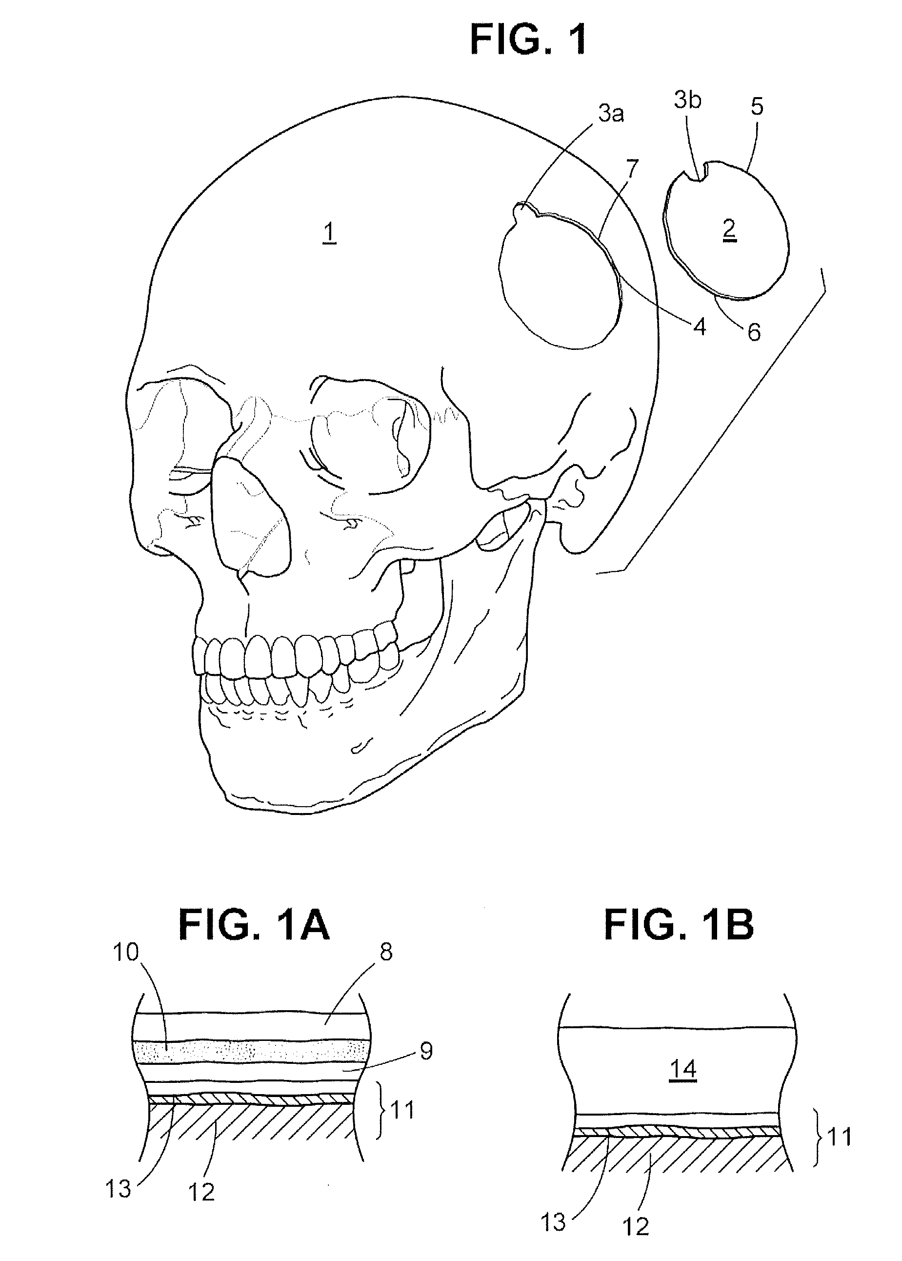 Craniotomy Closures and Plugs